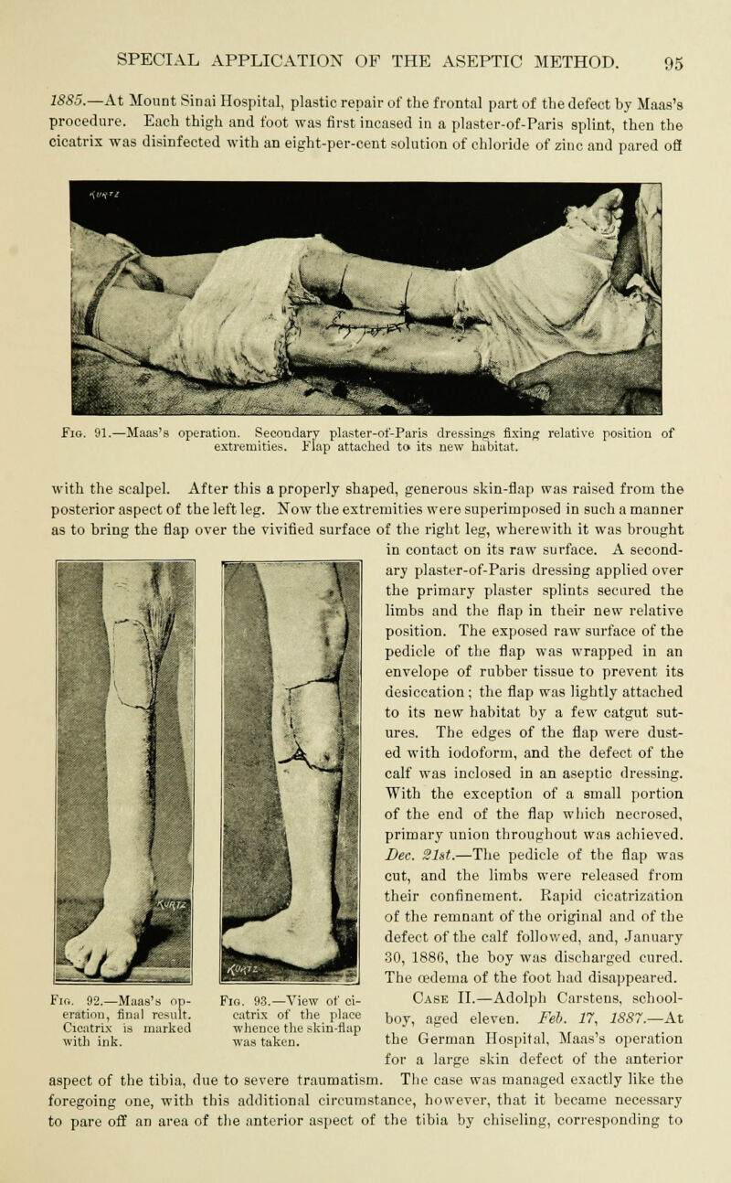 1885.—At Mount Sinai Hospital, plastic repair of the frontal part of the defect by Maas's procedure. Each thigh and foot was first incased in a plaster-of-Paris splint, then the cicatrix was disinfected with an eight-per-cent solution of chloride of zinc and pared off Fig. 91.—Maas's operation. Secondary plaster-of-Paris dressings fixing relative position of extremities. Flap attached to* its new habitat. with the scalpel. After this a properly shaped, generous skin-flap was raised from the posterior aspect of the left leg. Now the extremities were superimposed in such a manner as to bring the flap over the vivified surface of the right leg, wherewith it was brought in contact on its raw surface. A second- ary plaster-of-Paris dressing applied over the primary plaster splints secured the limbs and the flap in their new relative position. The exposed raw surface of the pedicle of the flap was wrapped in an envelope of rubber tissue to prevent its desiccation; the flap was lightly attached to its new habitat by a few catgut sut- ures. The edges of the flap were dust- ed with iodoform, and the defect of the calf was inclosed in an aseptic dressing. With the exception of a small portion of the end of the flap which necrosed, primary union throughout was achieved. Dec. 21st.—The pedicle of the flap was cut, and the limbs were released from their confinement. Rapid cicatrization of the remnant of the original and of the defect of the calf followed, and, January 30, 1886, the boy was discharged cured. The oedema of the foot had disappeared. Case II.—Adolph Carstens, school- boy, aged eleven. Feb. 17, 1887.—At the German Hospital, Maas's operation for a large skin defect of the anterior aspect of the tibia, due to severe traumatism. The case was managed exactly like the foregoing one, with this additional circumstance, however, that it became necessary to pare off an area of the anterior aspect of the tibia by chiseling, corresponding to Fib. 92.—Maas's op- eration, final result. Cicatrix is marked with ink. Fig. 93.—View of ci- catrix of the place whence the skin-flap was taken.