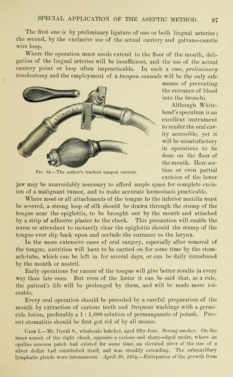 Fig. 94.—The author's tracheal tampon cannula. The first one is by preliminary ligature of one or both lingual arteries ; the second, by the exclusive use of the actual cautery and galvano-caustic wire loop. Where the operation must needs extend to the floor of the mouth, deli- gation of the lingual arteries will be insufficient, and the use of the actual cautery point or loop often impracticable. In such a case, preliminary tracheotomy and the employment of a tampon cannula will be the only safe means of preventing the entrance of blood into the bronchi. Although White- head's speculum is an excellent instrument to render the oral cav- ity accessible, yet it will be unsatisfactory in operations to be done on the floor of the mouth. Here sec- tion or even partial excision of the lower jaw may be unavoidably necessary to afford ample space for complete excis- ion of a malignant tumor, and to make accurate ha?mostasis practicable. Where most or all attachments of the tongue to the inferior maxilla must be severed, a strong loop of silk shovrid be drawn through the stump of the tongue near the epiglottis, to be brought out by the mouth and attached by a strip of adhesive plaster to the cheek. This precaution will enable the nurse or attendant to instantly clear the epiglottis should the stump of the tongue ever slip back upon and occlude the entrance to the larynx. In the more extensive cases of oral surgery, especially after removal of the tongue, nutrition will have to be carried on for some time by the stom- ach-tube, which can be left in for several days, or can be daily introduced by the mouth or nostril. Early operations for cancer of the tongue will give better results in every way than late ones. But even of the latter it can be said that, as a rule, the patient's life will be prolonged by them, and will be made more tol- erable. Every oral operation should be preceded by a careful preparation of the mouth by extraction of carious teeth and frequent washings with a germi- cide lotion, preferably a 1 : 1,000 solution of permanganate of potash. Pres- ent stomatitis should be first got rid of by all means. Case I.—Mr. David S., wholesale butcher, aged fifty-four. Strong smoker. On the inner aspect of the right cheek, opposite a carious and sharp-edged molar, where an opaline mucous patch had existed for some time, an elevated ulcer of the size of a silver dollar had established itself, and was steadily extending. The submaxillary lymphatic glands were intumescent. April 30, 188]}.—Extirpation of the growth from