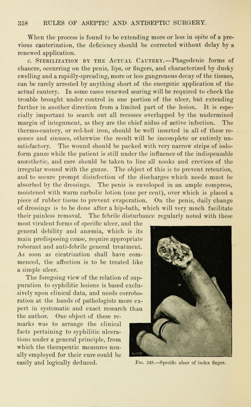 When the process is found to be extending more or less in spite of a pre- vious cauterization, the deficiency should be corrected without delay by a renewed application. c. Sterilization by the Actual Cautery.—Phagedenic forms of chancre, occurring on the penis, lips, or fingers, and characterized by dusky swelling and a rapidly-spreading, more or less gangrenous decay of the tissues, can be rarely arrested by anything short of the energetic application of the actual cautery. In some cases renewed searing will be required to check the trouble brought under control in one portion of the ulcer, but extending further in another direction from a limited part of the lesion. It is espe- cially important to search out all recesses overlapped by the undermined margin of integument, as they are the chief nidus of active infection. The thermo-cautery, or red-hot iron, should be well inserted in all of these re- cesses and sinuses, otherwise the result will be incomplete or entirely un- satisfactory. The wound should be packed with very narrow strips of iodo- form gauze while the patient is still under the influence of the indispensable anaesthetic, and care should be taken to line all nooks and crevices of the irregular wound with the gauze. The object of this is to prevent retention, and to secure prompt disinfection of the discharges which needs must be absorbed by the dressings. The penis is enveloped in an ample compress, moistened with warm carbolic lotion (one per cent), over which is placed a piece of rubber tissue to prevent evajioration. On the penis, daily change of dressings is to be done after a hip-bath, which will very much facilitate their painless removal. The febrile disturbance regularly noted with these most virulent forms of specific ulcer, and the general debility and anasmia, which is its main predisposing cause, require appropriate roborant and anti-febrile general treatment. As soon as cicatrization shall have com- menced, the affection is to be treated like a simple ulcer. The foregoing view of the relation of sup- puration to syphilitic lesions is based exclu- sively upon clinical data, and needs corrobo- ration at the hands of pathologists more ex- pert in systematic and exact research than the author. One object of these re- marks was to arrange the clinical facts pertaining to syphilitic ulcera- tions under a general principle, from which the therapeutic measures usu- ally employed for their cure could be easily and logically deduced. Fig. 248.—Specific ulcer of index finger.