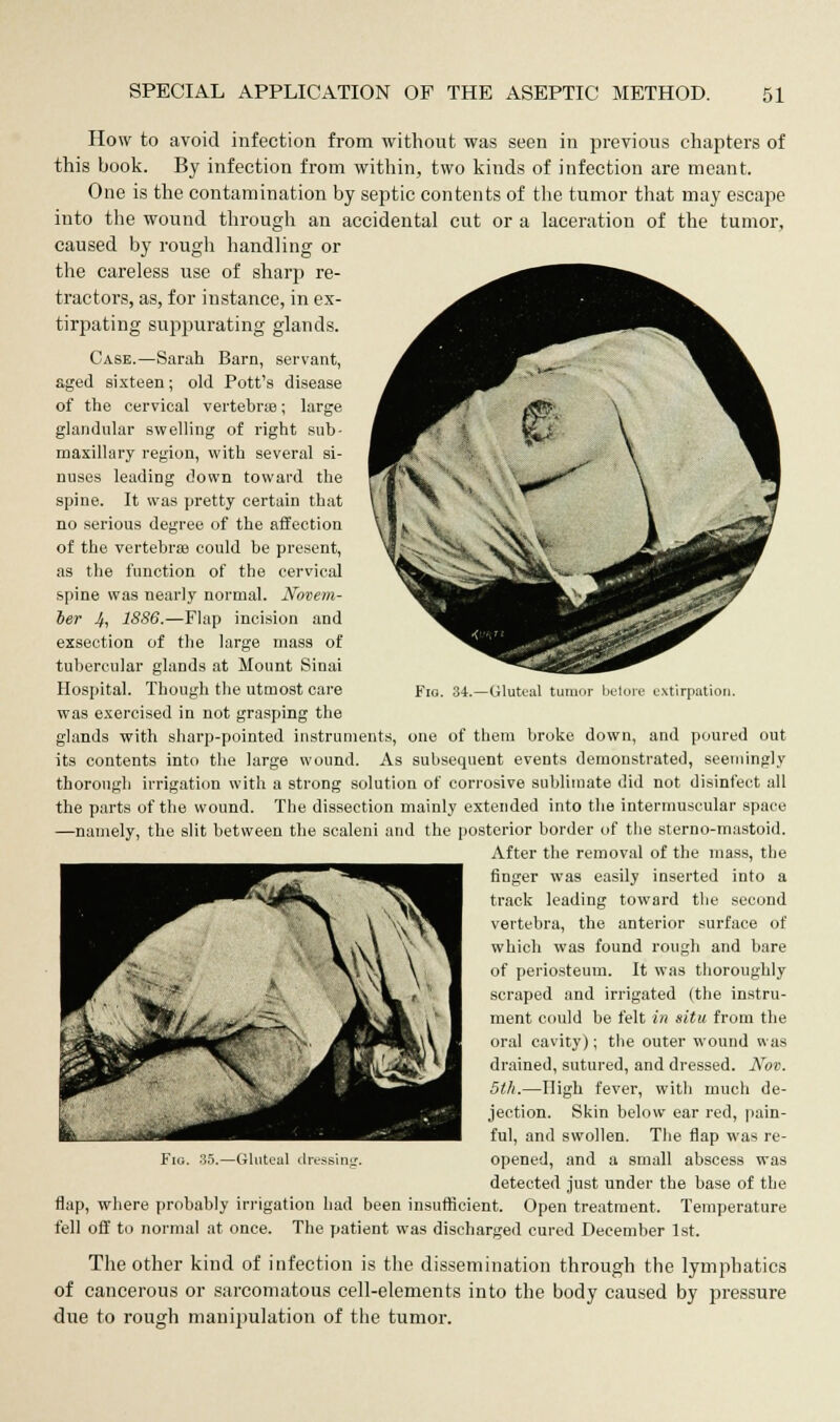 tumor betore extirpation. How to avoid infection from without was seen in previous chapters of this book. By infection from within, two kinds of infection are meant. One is the contamination by septic contents of the tumor that may escape into the wound through an accidental cut or a laceration of the tumor, caused by rough handling or the careless use of sharp re- tractors, as, for instance, in ex- tirpating suppurating glands. Case.—Sarah Barn, servant, aged sixteen; old Pott's disease of the cervical vertebrae; large glandular swelling of right sub- maxillary region, with several si- nuses leading down toward the spine. It was pretty certain that no serious degree of the affection of the vertebra could be present, as the function of the cervical spine was nearly normal. Novem- ber 4, 1886.—Flap incision and exsection of the large mass of tubercular glands at Mount Sinai Hospital. Though the utmost care was exercised in not grasping the glands with sharp-pointed instruments, one of them broke down, and poured out its contents into the large wound. As subsequent events demonstrated, seemingly thorough irrigation with a strong solution of corrosive sublimate did not disinfect all the parts of the wound. The dissection mainly extended into the intermuscular space —namely, the slit between the scaleni and the posterior border of the sterno-mastoid. After the removal of the mass, the finger was easily inserted into a track leading toward the second vertebra, the anterior surface of which was found rough and bare of periosteum. It was thoroughly scraped and irrigated (the instru- ment could be felt in situ from the oral cavity); the outer wound was drained, sutured, and dressed. Nov. 5th.—High fever, with much de- jection. Skin below ear red, pain- ful, and swollen. The flap was re- opened, and a small abscess was detected just under the base of the flap, where probably irrigation had been insufficient. Open treatment. Temperature fell off to normal at once. The patient was discharged cured December 1st. The other kind of infection is the dissemination through the lymphatics of cancerous or sarcomatous cell-elements into the body caused by pressure due to rough manipulation of the tumor. Gluteal dressing.