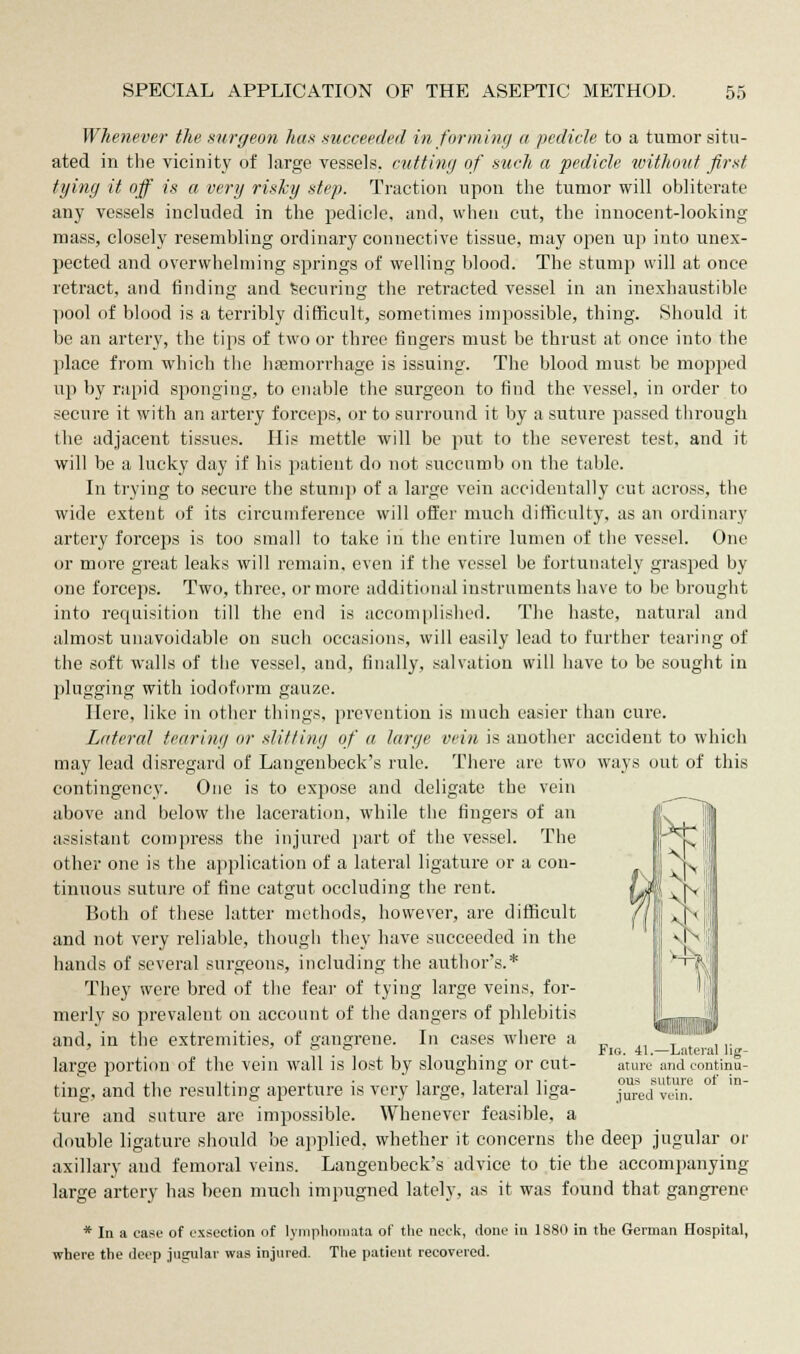 Whenever the surgeon has succeeded informing a pedicle to a tumor situ- ated in the vicinity of large vessels, cutting of such a pedicle without first tying it off is a very risky step. Traction upon the tumor will obliterate any vessels included in the pedicle, and, when cut, the innocent-looking mass, closely resembling ordinary connective tissue, may open up into unex- pected and overwhelming springs of welling blood. The stamp will at once retract, and finding and Securing the retracted vessel in an inexhaustible pool of blood is a terribly difficult, sometimes impossible, thing. Should it be an artery, the tips of two or three fingers must be thrust at once into the place from which the haemorrhage is issuing. The blood must be mopped up by rapid sponging, to enable the surgeon to find the vessel, in order to secure it with an artery forceps, or to surround it by a suture passed through the adjacent tissues. His mettle will be put to the severest test, and it will be a lucky day if his patient do not succumb on the table. In trying to secure the stump of a large vein accidentally cut across, the wide extent of its circumference will offer much difficulty, as an ordinary artery forceps is too small to take in the entire lumen of the vessel. One or more great leaks will remain, even if the vessel be fortunately grasped by one forceps. Two, three, or more additional instruments have to be brought into requisition till the end is accomplished. The haste, natural and almost unavoidable on such occasions, will easily lead to further tearing of the soft walls of the vessel, and, finally, salvation will have to be sought in plugging with iodoform gauze. Here, like in other things, prevention is much easier than cure. Lateral tearing or slitting of a large vein is another accident to which may lead disregard of Langenbeck's rule. There are two ways out of this contingency. One is to expose and deligate the vein above and below the laceration, while the fingers of an assistant compress the injured part of the vessel. The other one is the application of a lateral ligature or a con- tinuous suture of fine catgut occluding the rent. Both of these latter methods, however, are difficult and not very reliable, though they have succeeded in the hands of several surgeons, including the author's.* They were bred of the fear of tying large veins, for- merly so prevalent on account of the dangers of phlebitis and, in the extremities, of gangrene. In cases where a large portion of the vein wall is lost by sloughing or cut- ting, and the resulting aperture is very large, lateral liga- ture and suture are impossible. Whenever feasible, a double ligature should be applied, whether it concerns the deep jugular or axillary and femoral veins. Langenbeck's advice to tie the accompanying large artery has been much impugned lately, as it was found that gangrene * In a case of cxscction of lymphomata of the neck, done in 1880 in the German Hospital, where the deep jugular was injured. The patient recovered. Fig. 41.—Lateral lig- ature and continu- ous suture of in- jured vein.