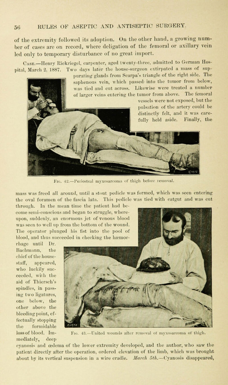 of the extremity followed its adoption. On the other hand, a growing num- ber of cases are on record, where deligation of the femoral or axillary vein led only to temporary disturbance of no great import. Case.—Henry Rickriegel, carpenter, aged twenty-three, admitted to German Hos- pital, March 2. 1887. Two days later the house-surgeon extirpated a mass of sup- purating glands from Scarpa's triangle of the right side. The saphenous vein, which passed into the tumor from below, was tied and cut across. Likewise were treated a number of larger veins entering the tumor from above. The femoral vessels were not exposed, but the pulsation of the artery could be distinctly felt, and it was care- fully held aside. Finally, the Fig. 4a.—Periosteal myxosarcoma of thigh before removal. mass was freed all around, until a stout pedicle was formed, which was seen entering the oval foramen of the fascia lata. This pedicle was tied with catgut and was cut through. In the mean time the patient had be- come semi-conscious and began to struggle, where- upon, suddenly, an enormous jet of venous blood was seen to well up from the bottom of the wound. The operator plunged his fist into the pool of blood, and thus succeeded in checking the hemor- rhage until Dr. Bachmann, the chief of the house- staff, appeared, who luckily suc- ceeded, wilh the aid of Thiersch's spindles, in pass- ing two ligatures, one below, the other above the bleeding point, ef- fectually stopping the formidable loss of blood. Im- mediately, deeji cyanosis and oedema of the lower extremity developed, and the author, who saw the patient directly after the operation, ordered elevation of the limb, which was brought about by its vertical suspension in a wire cradle. March 5th.—Cyanosis disappeared, United wounds after removal oi myxosarcoma of thigh.