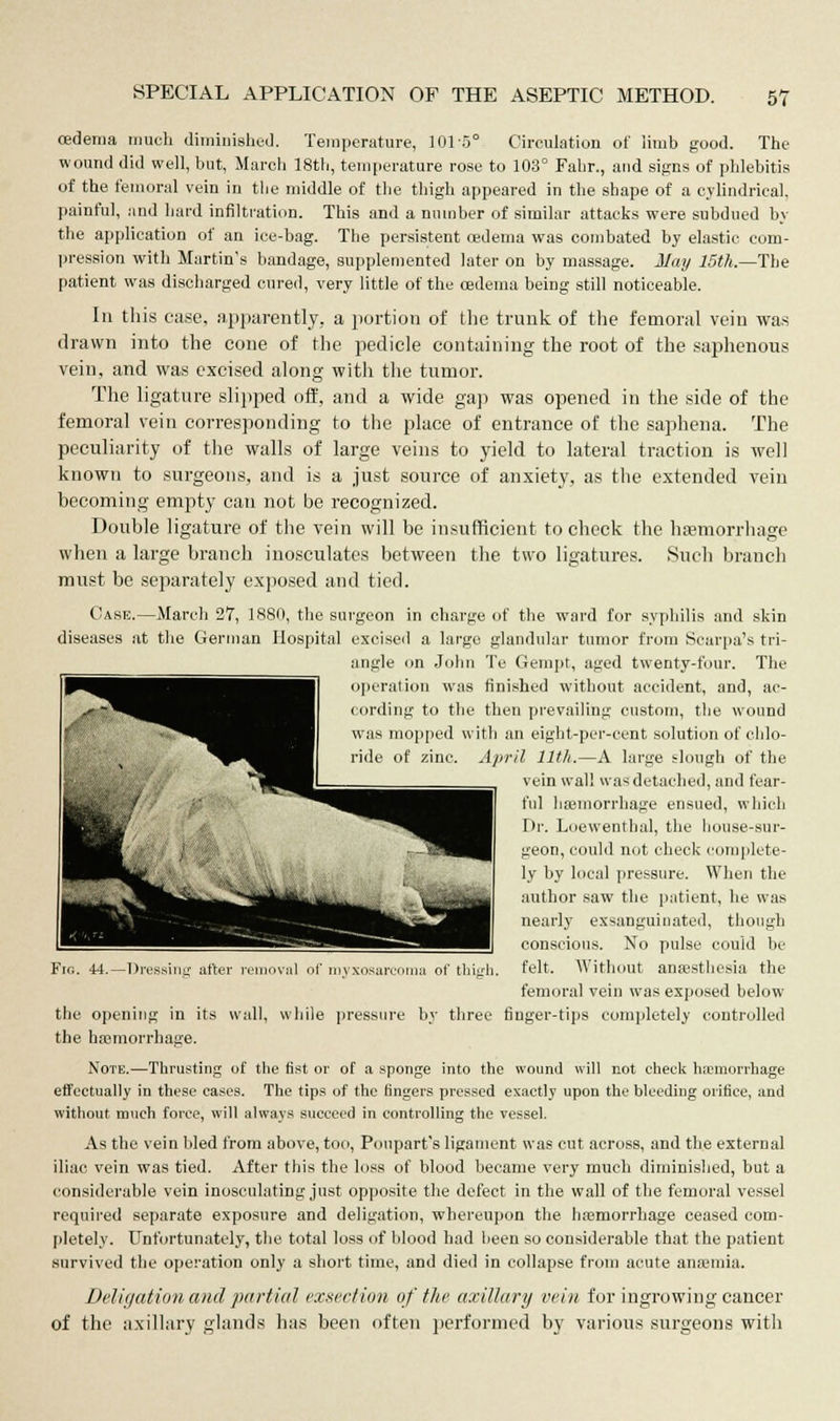 cedema much diminished. Temperature, 101 5° Circulation of limb good. The wound did well, but, March 18th, temperature rose to 103° Fahr., and signs of phlebitis of the femoral vein in the middle of the thigh appeared in the shape of a cylindrical, painful, and hard infiltration. This and a number of similar attacks were subdued by the application of an ice-bag. The persistent oedema was combated by elastic com- pression with Martin's bandage, supplemented later on by massage. May lBth.—The patient was discharged cured, very little of the cedema being still noticeable. In this case, apparently, a portion of the trunk of the femoral vein was drawn into the cone of the pedicle containing the root of the saphenous vein, and was excised along with the tumor. The ligature slipped off, and a wide gap was opened in the side of the femoral vein corresponding to the place of entrance of the saphena. The peculiarity of the walls of large veins to yield to lateral traction is well known to surgeons, and is a just source of anxiety, as the extended vein becoming empty can not be recognized. Double ligature of the vein will be insufficient to check the hemorrhage when a large branch inosculates between the two ligatures. Such branch must be separately exposed and tied. Case.—March 27, 1880, the surgeon in charge of the ward for syphilis and skin diseases at the German Hospital excised a large glandular tumor from Scarpa's tri- angle on John Te Gempt, aged twenty-four. The operation was finished without accident, and, ac- cording to the then prevailing custom, the wound was mopped with an eight-per-cent solution of chlo- ride of zinc. April 11th.—A large slough of the vein wall was detached, and fear- ful haemorrhage ensued, which Dr. Loewenthal, the house-sur- geon, could not check complete- ly by local pressure. When the author saw the patient, he was nearly exsanguinated, though conscious. No pulse could be felt. Without anaesthesia the femoral vein was exposed below the opening in its wall, while pressure by three finger-tips completely controlled the haemorrhage. Note.—Thrusting of the fist or of a sponge into the wound will not check haemorrhage effectually in these eases. The tips of the lingers pressed exactly upon the bleeding orifice, and without much force, will always succeed in controlling the vessel. As the vein bled from above, too, Poupart's ligament was cut across, and the external iliac vein was tied. After this the loss of blood became very much diminished, but a considerable vein inosculating just opposite the defect in the wall of the femoral vessel required separate exposure and deligation, whereupon the haemorrhage ceased com- pletely. Unfortunately, the total loss of blood had been so considerable that the patient survived the operation only a short time, and died in collapse from acute anaemia. Deligation and partial exsection of the, axillary vein for ingrowing cancer of the axillary glands has been often performed by various surgeons with ma of thigh.