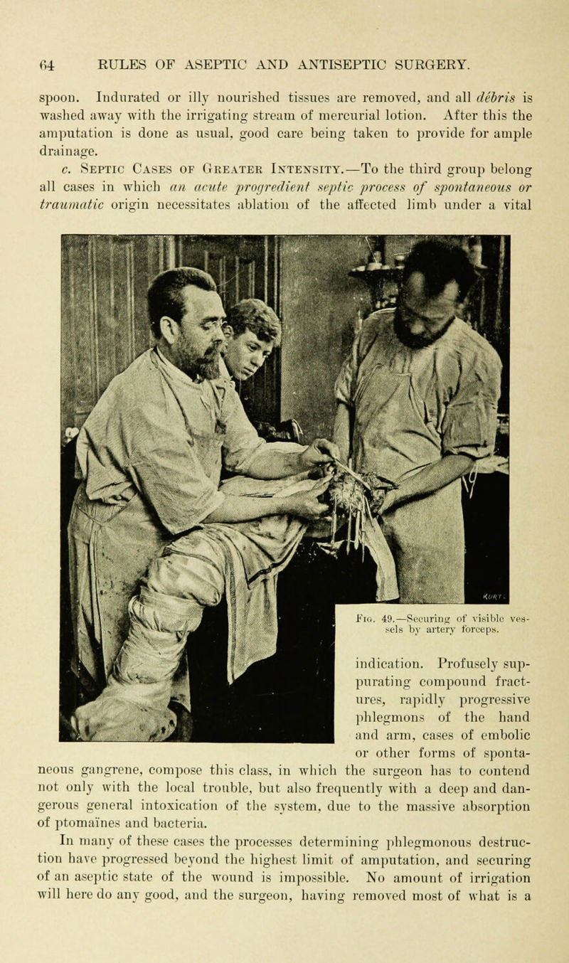 spoon. Indurated or illy nourished tissues are removed, and all debris is washed away with the irrigating stream of mercurial lotion. After this the amputation is done as usual, good care being taken to provide for ample drainage. c. Septic Cases of Greater Intensity.—To the third group belong all cases in which an acute progredient septic process of spontaneous or traumatic origin necessitates ablation of the affected limb under a vital Fin. 49.—Securing of visible ves- sels by artery forceps. indication. Profusely sup- purating compound fract- ures, rapidly progressive ihlegmons of the hand and arm, cases of embolic or other forms of sponta- neous gangrene, compose this class, in which the surgeon has to contend not only with the local trouble, but also frequently with a deep and dan- gerous general intoxication of the system, due to the massive absorption of ptomaines and bacteria. In many of these cases the processes determining phlegmonous destruc- tion have progressed beyond the highest limit of amputation, and securing of an aseptic state of the wound is impossible. No amount of irrigation will here do any good, and the surgeon, having removed most of what is a