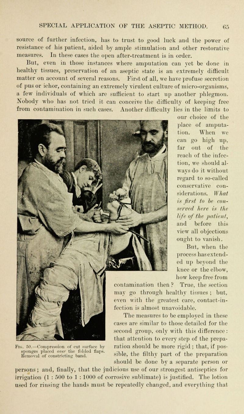 source of further infection, has to trust to good luck and the power of resistance of his patient, aided by ample stimulation and other restorative measures. In these cases the open after-treatment is in order. But, even in those instances where amputation can yet be done in healthy tissues, preservation of an aseptic state is an extremely difficult matter on account of several reasons. First of all, we have profuse secretion of pus or ichor, containing an extremely virulent culture of micro-organisms, a few individuals of which are sufficient to start up another phlegmon. Nobody who has not tried it can conceive the difficulty of keeping free from contamination in such cases. Another difficulty lies in the limits to our choice of the place of amputa- tion. When we can go high up, far out of the reach of the infec- tion, we should al- ways do it without regard to so-called conservative con- siderations. What is first to be con- served here is the life of the patient, and before this view all objections ought to vanish. But, when the process has extend- ed up beyond the knee or the elbow, how keep free from ition then ? True, the section through healthy tissues ; but, i the greatest care, contact-in- almost unavoidable, easnres to be employed in these limilar to those detailed for the oup, only with this difference: that attention to every step of the prepa- ration should be more rigid : that, if pos- sible, the filthy part of the preparation should be done by a separate person or persons; and, finally, that the judicious use of our strongest antiseptics for irrigation (1 : 500 to 1 : 1000 of corrosive sublimate) is justified. The lotion used for rinsing the hands must be repeatedly changed, and everything that cases i second Flu. 50.—Compression of cut surface by sponges placed over the folded flaps. Removal of constricting band.