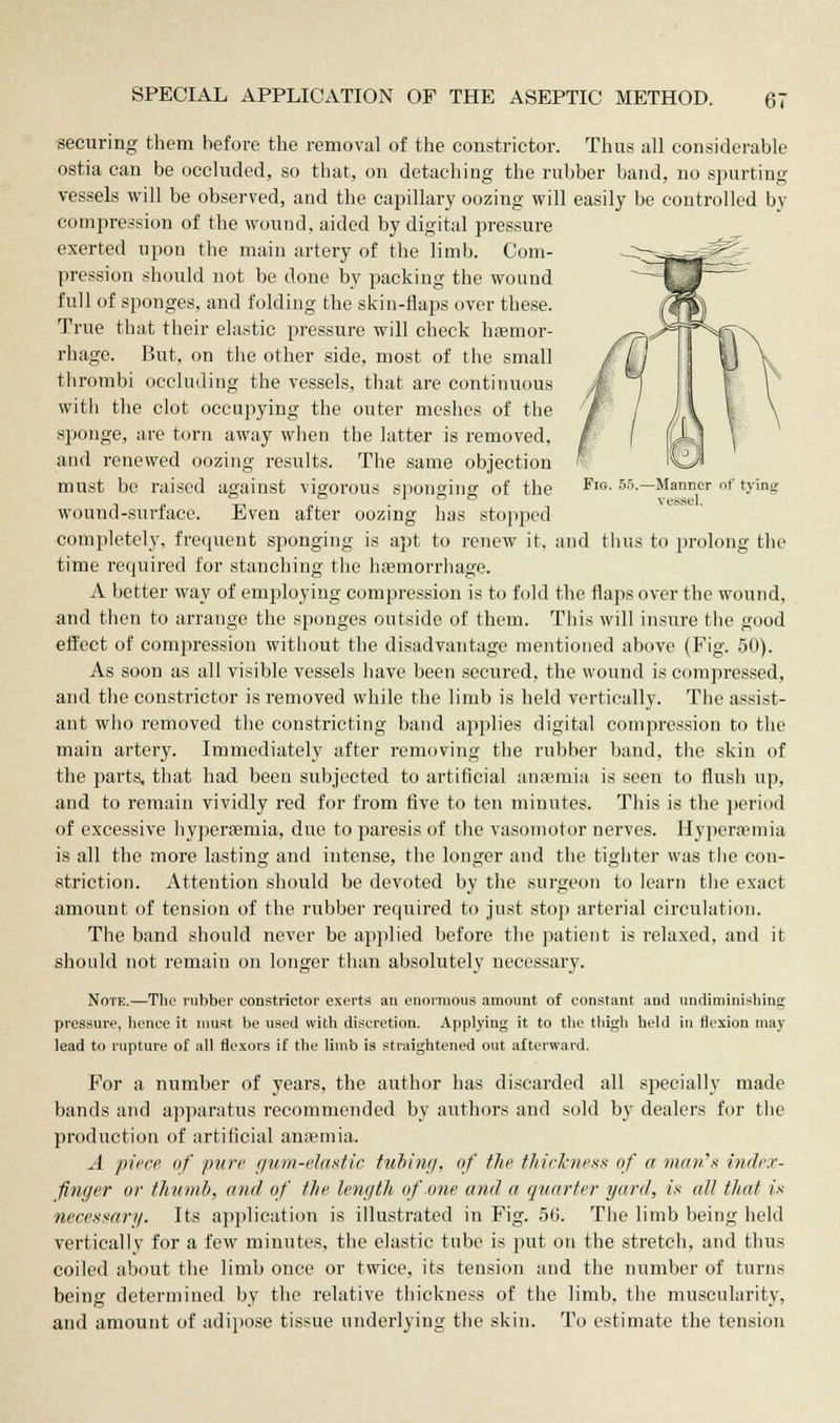 securing them before the removal of the constrictor. Thus all considerable ostia can be occluded, so that, on detaching the rubber band, no spurting vessels will be observed, and the capillary oozing will easily be controlled by compression of the wound, aided by digital pressure exerted upon the main artery of the limb. Com- pression should not be done by packing the wound full of sponges, and folding the skin-flaps over these. True that their elastic pressure will check haemor- rhage. But, on the other side, most of the small thrombi occluding the vessels, that are continuous with the clot occupying the outer meshes of the sponge, are torn away when the latter is removed, and renewed oozing results. The same objection must be raised against vigorous sponging of the FlG- 55.—Manner of tying wound-surface. Even after oozing has stopped completely, frequent sponging is apt to renew it, and thus to prolong the time required for stanching the haemorrhage. A better way of employing compression is to fold the flaps over the wound, and then to arrange the sponges outside of them. This will insure the good effect of compression without the disadvantage mentioned above (Fig. 50). As soon as all visible vessels have been secured, the wound is compressed, and the constrictor is removed while the limb is held vertically. The assist- ant who removed the constricting band applies digital compression to the main artery. Immediately after removing the rubber band, the skin of the parts, that had been subjected to artificial anaemia is seen to flush up, and to remain vividly red for from five to ten minutes. This is the period of excessive hyperemia, due to paresis of the vasomotor nerves. Hyperemia is all the more lasting and intense, the longer and the tighter was the con- striction. Attention should be devoted by the surgeon to learn the exact amount of tension of the rubber required to just stop arterial circulation. The band should never be applied before the patient is relaxed, and it- should not remain on longer than absolutely necessary. Note.—The rubber constrictor exerts an enormous amount of constant and undiminishing pressure, hence it must be used with discretion. Applying it to the thigh held in flexion may lead to rupture of all flexors if the limb is straightened out afterward. For a number of years, the author has discarded all specially made bands and apparatus recommended by authors and sold by dealers for the production of artificial anaemia. A piece of pure gum-elastic tubing, of the thickness of a man's index- finger or thumb, and of the length of one and a quarter- yard, is all that is necessary. Its application is illustrated in Fig. 56. The limb being held vertically for a few minutes, the elastic tube is put on the stretch, and thus coiled about the limb once or twice, its tension and the number of turns being determined by the relative thickness of the limb, the muscularity, and amount of adipose tissue underlying the skin. To estimate the tension