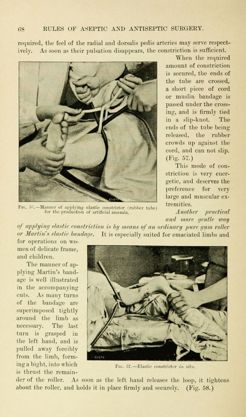 Fir,. 51.—Manner of applying elastic constrictor (rubber tube) for the production of artificial anaemia. required, the feel of the radial and dorsalis pedis arteries may serve respect- ively. As soon as their pulsation disappears, the constriction is sufficient. When the required amount of constriction is secured, the ends of the tube are crossed, a short piece of cord or muslin bandage is passed under the cross- ing, and is firmly tied in a slip-knot. The ends of the tube being released, the rubber crowds up against the cord, and can not slij). (Fig. 57.) This mode of con- striction is very ener- getic, and deserves the preference for very large and muscular ex- tremities. Another practical and more gentle ivay of applying elastic constriction is by means of an ordinary pure gum roller or Martin's elastic bandage. It is especially suited for emaciated limbs and for operations on wo- men of delicate frame, and children. The manner of ap- plying Martin's band- age is well illustrated in the accompanying cuts. As many turns of the bandage are superimposed tightly around the limb as necessary. The last turn is grasped in the left hand, and is pulled away forcibly from the limb, form- ing a bight, into which is thrust the remain- der of the roller. As soon as the left hand releases the loop, it tightens about the roller, and holds it in place firmly and securely. (Fig. 58.)