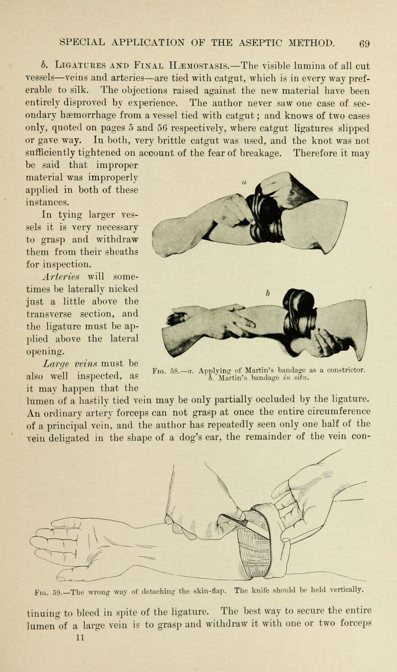 b. Ligatures and Final HiEMOSTAsis.—The visible lumina of all cut vessels—veins and arteries—are tied with catgut, which is in every way pref- erable to silk. The objections raised against the new material have been entirely disproved by experience. The author never saw oue case of sec- ondary haemorrhage from a vessel tied with catgut; and knows of two cases only, quoted on pages 5 and 56 respectively, where catgut ligatures slipped or gave way. In both, very brittle catgut was used, and the knot was not sufficiently tightened on account of the fear of breakage. Therefore it may be said that improper material was improperly applied in both of these instances. In tying larger ves- sels it is very necessary to grasp and withdraw them from their sheaths for inspection. Arteries will some- times be laterally nicked just a little above the transverse section, and the ligature must be ap- plied above the lateral opening. Fig. 58. Applyinj of Martin's bandage as a constrictor. pplvin;  h.' Ma irtin's bandage in sit. Large veins must be also well inspected, as it may happen that the lumen of a hastily tied vein may be only partially occluded by the ligature. An ordinary artery forceps can not grasp at once the entire circumference of a principal vein, and the author has repeatedly seen only one half of the vein deligated in the shape of a dog's ear, the remainder of the vein cod- Fm. 50.—The wronjr way of detaching the skin-flap. The knife should be held vertically. tinuing to bleed in spite of the ligature. The best way to secure the entire lumen of a large vein is to grasp and withdraw it with one or two forceps 11