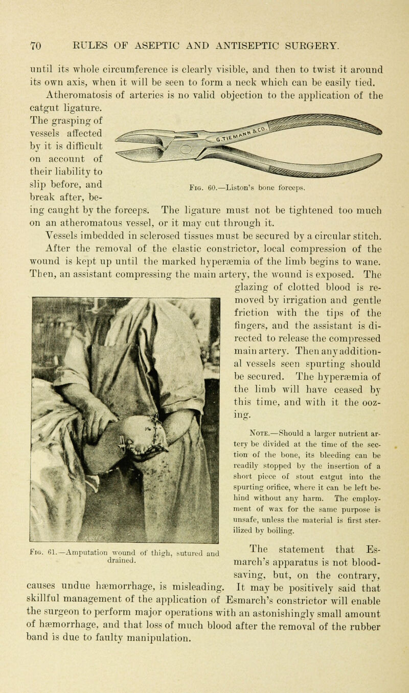 Fig. 60.—Liston's bone forceps. until its whole circumference is clearly visible, and then to twist it around its own axis, when it will be seen to form a neck which can be easily tied. Atheromatosis of arteries is no valid objection to the application of the catgut ligature. The grasping of vessels affected by it is difficult on account of their liability to slij) before, and break after, be- ing caught by the forceps. The ligature must not be tightened too much on an atheromatous vessel, or it may cut through it- Vessels imbedded in sclerosed tissues must be secured by a circular stitch. After the removal of the elastic constrictor, local compression of the wound is kept up until the marked hyperemia of the limb begins to wane. Then, an assistant compressing the main artery, the wound is exposed. The glazing of clotted blood is re- moved by irrigation and gentle friction with the tips of the fingers, and the assistant is di- rected to release the compressed main artery. Then anyaddition- al vessels seen spurting should be secured. The hyperemia of the limb will have ceased by this time, and with it the ooz- Note.—Should a larger nutrient ar- tery be divided at the time of the sec- tion of the bone, its bleeding can be readily stopped by the insertion of a short piece of stout catgut into the spurting orifice, where it can be left be- hind without any harm. The employ- ment of wax for the same purpose is unsafe, unless the material is first ster- ilized by boiling. The statement that Es- march's apparatus is not blood- saving, but, on the contrary, causes undue hasmorrhage, is misleading. It may be positively said that skillful management of the application of Esmarch's constrictor will enable the surgeon to perform major operations with an astonishingly small amount of hemorrhage, and that loss of much blood after the removal of the rubber band is due to faulty manipulation. drained.