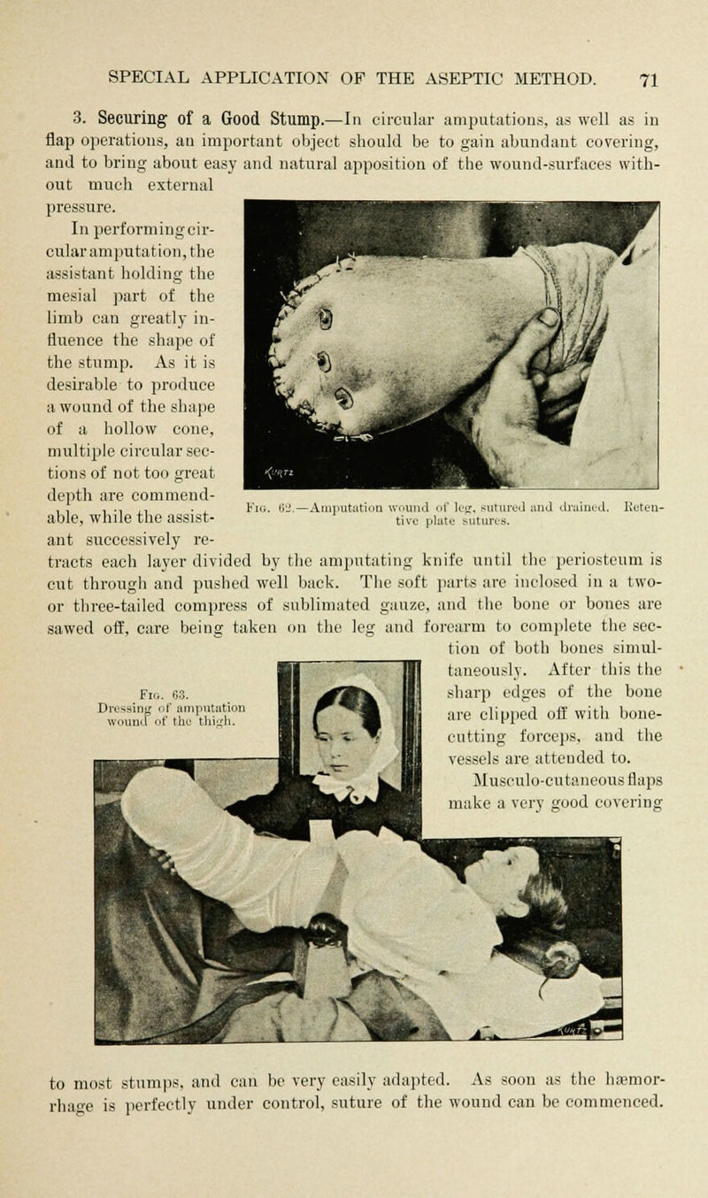 3. Securing of a Good Stump.—In circular amputations, as well as in flap operations, an important object should be to gain abundant covering, and to bring about easy and natural apposition of the wound-surfaces with- out much external pressure. In performing cir- cular amputation, the assistant holding the mesial part of the limb can greatly in- fluence the shape of the stump. As it is desirable to produce a wound of the shape of a hollow cone, multiple circular sec- tions of not too great depth are commend- able, while the assist- ant successively re- tracts each layer divided by the amputating knife until the periosteum is cut through and pushed well back. The soft parts are inclosed in a two- or three-tailed compress of sublimated gauze, and the bone or bones are sawed off, care being taken on the leg and forearm to complete the sec- tion of both bones simul- taneously. After this the sharp edges of the bone are clipped off with bone- cutting forceps, and the vessels are atteuded to. Musculocutaneous flaps make a very good covering Fig. 62 -Amputation wound of leg, sutured and drained. Reten- tive platu sutures. Fig. 63. Dressing of amputation wounu of the thigh. to most stumps, and can be very easily adapted. As soon as the haemor- rhage is perfectly under control, suture of the wound can be commenced.