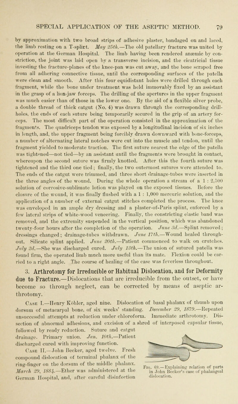 by approximation with two broad strips of adhesive plaster, bandaged on and laced, the limb resting on a T-splict. May 25th.—The old patellary fracture was united by operation at tlie German Hospital. The limb having been rendered anaemic by con- striction, the joint was laid open by a transverse incision, and the cicatricial tissue investing the fracture-planes of the knee-pan was cut away, and the bone scraped free from all adhering connective tissue, until the corresponding surfaces of the patella were clean and smooth. After this four equidistant holes were drilled through each fragment, while the bone under treatment was held immovably fixed by an assistant in the grasp of a lion-jaw forceps. The drilling of the apertures in the upper fragment was much easier than of those in the lower one. By the aid of a flexible silver probe, a double thread of thick catgut (No. 4) was drawn through the corresponding drill- holes, the ends of each suture being temporarily secured in the grip of an artery for- ceps. The most difficult part of the operation consisted in the approximation of the fragments. The quadriceps tendon was exposed by a longitudinal incision of six inches in length, and, the upper fragment being forcibly drawn downward with bone-forceps, a number of alternating lateral notches were cut into the muscle and tendon, until the fragment yielded to moderate traction. The first suture nearest the edge of the patella was tightened—not tied—by an assistant until the fragments were brought in contact, whereupon the second suture was firmly knotted. After this the fourth suture was tightened and the third one tied; finally, the two outermost sutures were attended to. The ends of the catgut were trimmed, and three short drainage-tubes were inserted in the three angles of the wound. During the whole operation a stream of a 1 : 2,500 solution of corrosive-sublimate lotion was played on the exposed tissues. Before the closure of the wound, it was finally flushed with a 1 : 1,000 mercuric solution, and the application of a number of external catgut stitches completed the process. The knee was enveloped in an ample dry dressing and a plaster-of-Paris splint, enforced by a few lateral strips of white-wood veneering. Finally, the constricting elastic, band was removed, and the extremity suspended in the vertical position, which was abandoned twenty-four hours after the completion of the operation. June 3d.—Splint removed; dressings changed; drainage-tubes withdrawn. June 17th.—Wound healed through- out. Silicate splint applied. June 20th.—Patient commenced to walk on crutches. July 2<l.—She was discharged cured. July 13th.—The union of sutured patella was found firm, the operated limb much more useful than its mate. Flexion could be car- ried to a right angle. The course of healing of the case was feverless throughout. 3. Arthrotomy for Irreducible or Habitual Dislocation, and for Deformity- due to Fracture.—Dislocations that are irreducible from the outset, or have become so through neglect, can be corrected by means of aseptic ar- throtomy. Case I.—Henry Kohler, aged nine. Dislocation of basal phalanx of thumb upon dorsum of metacarpal bone, of six weeks' standing. Decemher 29, 1879.—Repeated unsuccessful attempts at reduction under chloroform. Immediate arthrotomy. Dis- section of abnormal adhesions, and excision of a shred of interposed capsular tissue, followed by ready reduction. Suture and catgut drainage. Primary union. Jan. 10th.—Patient discharged cured with improving function. Case II.— John Becker, aged twelve. Fresh compound dislocation < >t terminal phalanx of the ring-finger on the dorsum of the middle phalanx. b 6 „, , . . , it Fio. 69.—Explaining relation of parts March 29, ISSJf.— Ether was administered at the in John Becker's ease of phalangeal German Hospital, ami, after careful disinfection dislocation.