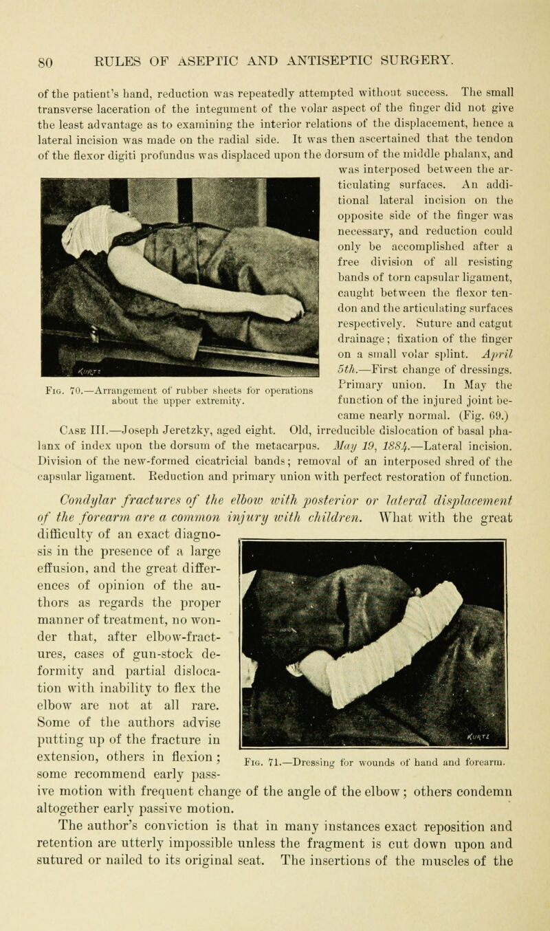 Fig. 70.- - Arrangement of rubber sheets for opi about the upper extremity. of the patieDt's band, reduction was repeatedly attempted without success. The small transverse laceration of the integument of the volar aspect of the finger did not give the least advantage as to examining the interior relations of the displacement, hence a lateral incision was made on the radial side. It was then ascertained that the tendon of the flexor digiti profundus was displaced upon the dorsum of the middle phalanx, and was interposed between the ar- ticulating surfaces. An addi- tional lateral incision on the opposite side of the finger was necessary, and reduction could only be accomplished after a free division of all resisting bands of torn capsular ligament, caught between the flexor ten- don and the articulating surfaces respectively. Suture and catgut drainage; fixation of the finger on a small volar splint. April 5th.—First change of dressings. Primary union. In May the function of the injured joint be- came nearly normal. (Fig. 09.) Case III.—Joseph Jeretzky, aged eight. Old, irreducible dislocation of basal pha- lanx of index upon the dorsum of the metacarpus. May 19, ISSJf.—Lateral incision. Division of the new-formed cicatricial bands; removal of an interposed shred of the capsular ligament. Reduction and primary union with perfect restoration of function. Condylar fractures of the elbow tvifh posterior or lateral displacement of the forearm are a common injury with children. What with the great difficulty of an exact diagno- sis in the presence of a large effusion, and the great differ- ences of opinion of the au- thors as regards the proper maimer of treatment, no won- der that, after elbow-fract- ures, cases of gun-stock de- formity and partial disloca- tion with inability to flex the elbow are not at all rare. Some of the authors advise putting up of the fracture in extension, others in flexion ; some recommend early pass- ive motion with frequent change of the angle of the elbow; others condemn altogether early passive motion. The author's conviction is that in many instances exact reposition and retention are utterly impossible unless the fragment is cut down upon and sutured or nailed to its original seat, The insertions of the muscles of the