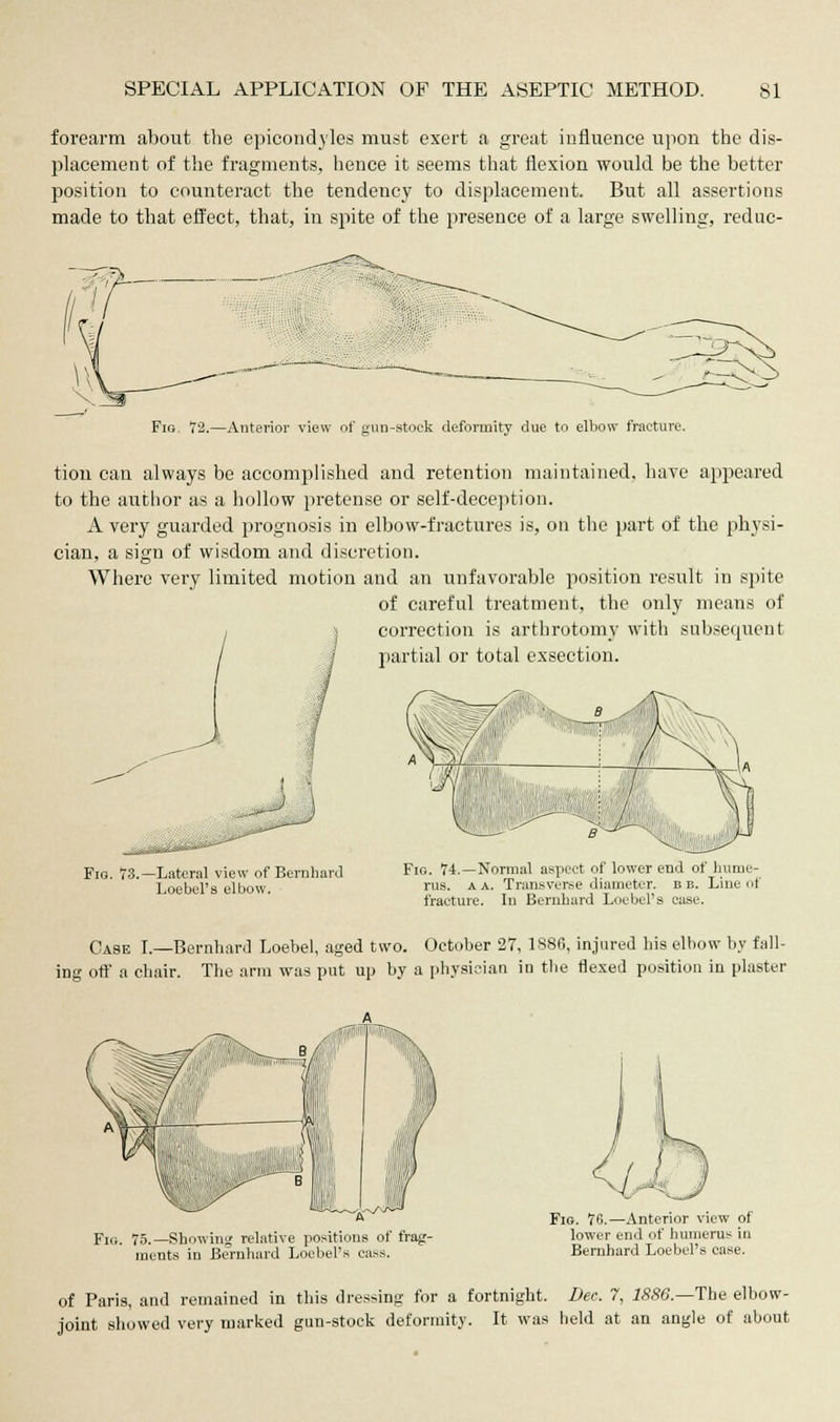 forearm about the epicondyles must exert a great influence upon the dis- placement of the fragments, hence it seems that flexion would be the better position to counteract the tendency to displacement. But all assertions made to that effect, that, in spite of the presence of a large swelling, reduc- Fig. 72.—Anterior view of gun-stock deformity due to elbow fracture. tion can always be accomplished and retention maintained, have appeared to the author as a hollow pretense or self-deception. A very guarded prognosis in elbow-fractures is, on the part of the physi- cian, a sign of wisdom and discretion. Where very limited motion and an unfavorable position result in spite of careful treatment, the only means of correction is arthrotomy with subsequent partial or total exsection. ^ Fig. 73.—Lateral view of Bernhard Loebel's elbow. Fig. 74.—Normal aspect of lower end of hume- rus, a A. Transverse diameter. B e. Line of fracture. In Bernhard Loebel's case. Case I.—Bernhard Loebel, aged two. October 27, 1886, injured his elbow by fall- ing off a chair. The arm was put up by a physician in the flexed position in plaster Fig. 75.—Showing relative positions of frag- ments in Bernhard Loebel's cass. Fig. 78.—Anterior view of lower end of humerus in Bernhard Loebel's ease. of Paris, and remained in this dressing for a fortnight. Dec. 7, 1886.—The elbow- joint showed very marked gun-stock deformity. It was held at an angle of about