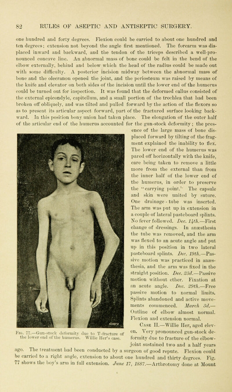 one hundred and forty degrees. Flexion could be carried to about one hundred and ten degrees; extension not beyond the angle first mentioned. The forearm was dis- placed inward and backward, and the tendon of the triceps described a well-pro- nounced concave line. An abnormal mass of bone could be felt in the bend of the elbow externally, behind and below which the head of the radius could be made out with some difficulty. A posterior incision midway between the abnormal mass of bone and the olecranon opened the joint, and the periosteum was raised by means of the knife and elevator on both sides of the incision until the lower end of the humerus could be turned out for inspection. It was found that the deformed callus consisted of the external epicondyle, capitellum, and a small portion of the trochlea that had been broken off obliquely, and was tilted and pulled forward by the action of the flexors so as to present its articular aspect forward, part of the fractured surface looking back- ward. In this position bony union bad taken place. The elongation of the outer half of the articular end of the humerus accounted for the gun-stock deformity; the pres- ence of the large mass of bone dis- placed forward by tilting of the frag- ment explained the inability to flex. The lower end of the humerus was pared off horizontally with the knife, care being taken to remove a little more from the external than from the inner half of the lower end of the humerus, in order to preserve the carrying point.'' The capsule and skin were united by suture. One drainage - tube was inserted. The arm was put up in extension in a couple of lateral pasteboard splints. No fever followed. Dec. 14th.—First change of dressings. In anaasthesia the tube was removed, and the arm was flexed to an acute angle and put up in this position in two lateral pasteboard splints. Dec. 19th.—Pas- sive motion was practiced in anaes- thesia, and the arm was fixed in the straight position. Dec. 23d.—Passive motion without ether. Fixation at an acute angle. Dec. 29th.—Free passive motion to normal limits. Splints abandoned and active move- ments commenced. March 3d.— Outline of elbow almost normal. Flexion and extension normal. Case II.—Willie Her, aged elev- en. Very pronounced gun-stock de- formity due to fracture of the elbow- joint sustained two and a half years ago. The treatment had been conducted by a surgeon of good repute. Flexion could be carried to a right angle, extension to about one hundred and thirty degrees. Fig. 77 shows the boy's arm in full extension. June 17, 1887.—Arthrotomy done at Mount Fig. 77.—Gun-stocK deformity the lower end of the humerus. le to T-tracture of Willie Her's ease.