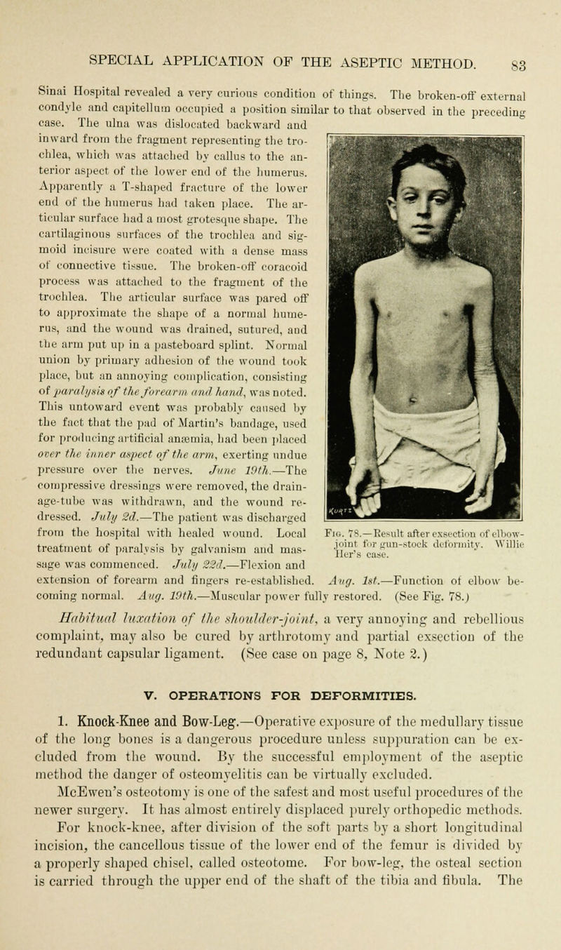 Sinai Hospital revealed a very curious condition of things. The broken-off external condyle and capitellum occupied a position similar to that observed in the preceding case. The ulna was dislocated backward and inward from the fragment representing the tro- chlea, which was attached by callus to the an- terior aspect of the lower end of the humerus. Apparently a T-shaped fracture of the lower end of the humerus had taken place. The ar- ticular surface had a most grotesque shape. The cartilaginous surfaces of the trochlea and sig- moid incisure were coated with a dense mass of connective tissue. The broken-off coracoid process was attached to the fragment of the trochlea. The articular surface was pared off to approximate the shape of a normal hume- rus, and the wound was drained, sutured, and the arm put up in a pasteboard splint. Normal union by primary adhesion of the wound took place, but an annoying complication, consisting of paralysis of the forearm and hand, was noted. This untoward event was probably caused by the fact that the pad of Martin's bandage, used for producing artificial anaemia, had been placed over the inner aspect of the arm, exerting undue pressure over the nerves. June 10th.—The compressive dressings were removed, the drain- age-tube was withdrawn, and the wound re- dressed. July 2d.—The patient was discharged from the hospital with healed wound. Local treatment of paralysis by galvanism and mas- sage was commenced. July 22d.—Flexion and extension of forearm and fingers re-established. Aug. 1st.—Function of elbow be- coming normal. Aug. 19th.—Muscular power fully restored. (See Fig. 78.) Habitual luxation of the shoulder-joint, a very annoying and rebellions complaint, may also be cured by arthrotomy and partial exsection of the redundant capsular ligament. (See case on page 8, Note 2.) Fig. 78.—Result after exsection of elbow- joint for gun-stock deformity. Willie tier's case. V. OPERATIONS FOR DEFORMITIES. 1. Knock-Knee and Bow-Leg.—Operative exposure of the medullary tissue of the long bones is a dangerous procedure unless suppuration can be ex- cluded from the wound. By the successful employment of the aseptic- method the danger of osteomyelitis can be virtually excluded. McEwen's osteotomy is one of the safest and most useful procedures of the newer surgery. It has almost entirely displaced purely orthopedic methods. For knock-knee, after division of the soft parts by a short longitudinal incision, the cancellous tissue of the lower end of the femur is divided by a properly shaped chisel, called osteotome. For bow-leg, the osteal section is carried through the upper end of the shaft of the tibia and fibula. The