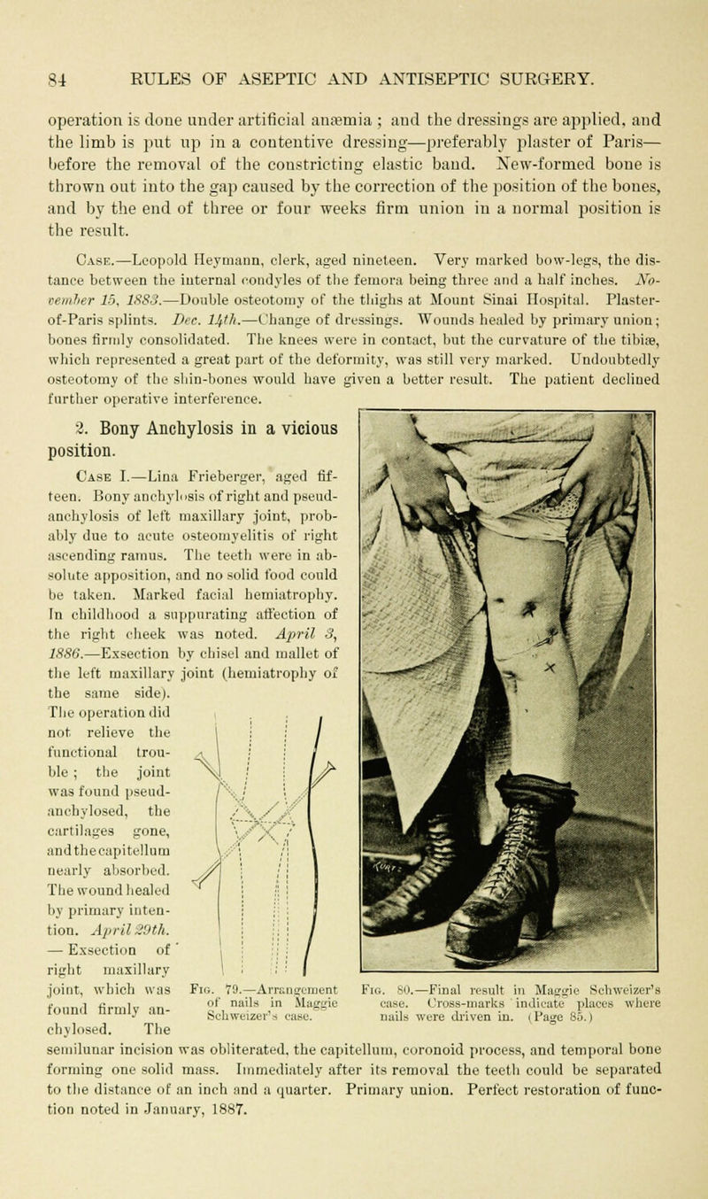 operation is done under artificial anaemia ; and the dressings are applied, and the limb is put up in a contentive dressing—preferably plaster of Paris— before the removal of the constricting elastic band. New-formed bone is thrown out into the gap caused by the correction of the position of the bones, and by the end of three or four weeks firm union in a normal position is the result. Case.—Leopold Heymann, clerk, aged nineteen. Very marked bow-legs, the dis- tance between the internal condyles of the femora being three and a half inches. No- vember 15, 1883.—Double osteotomy of the thighs at Mount Sinai Hospital. Plaster- of-Paris splints. Dec. 14th.—Change of dressings. Wounds healed by primary union; bones firmly consolidated. The knees were in contact, but the curvature of the tibise, which represented a great part of the deformity, was still very marked. Undoubtedly osteotomy of the shin-bones would have given a better result. The patient declined further operative interference. 2. Bony Anchylosis in a vicious position. Case I.—Lina Frieberger, aged fif- teen. Bony anchyh >sis of right and pseud- anchylosis of left maxillary joint, prob- ably due to acute osteomyelitis of right ascending ramus. The teeth were in ab- solute apposition, and no solid food could be taken. Marked facial hemiatrophy. In childhood a suppurating affection of the right cheek was noted. April 3, 1886.—Exseetion by chisel and mallet of the left maxillary joint (hemiatrophy of the same side). The operation did not relieve the functional trou- ble ; the joint was found pseud- anchylosed, the cartilages gone, andthecapitullum nearly absorbed. The wound healed by primary inten- tion. April 29th. — Exseetion of right maxillary joint, which was found firmly an- chylosed. The semilunar incision was obliterated, the capitellum, coronoid process, and temporal bone forming one solid mass. Immediately after its removal the teeth could be separated to the distance of an inch and a quarter. Primary union. Perfect restoration of func- tion noted in January, 1887. 4s, [-■■ V ■'■:■. / ' -'• \,f Fig 79.—Arrangement of nails in Maggie Schweizer'a ease. Fn i. SO.—Final result in Maggie Schweizer's case. Cross-marks indicate places where nails were driven in. (Page 85.)