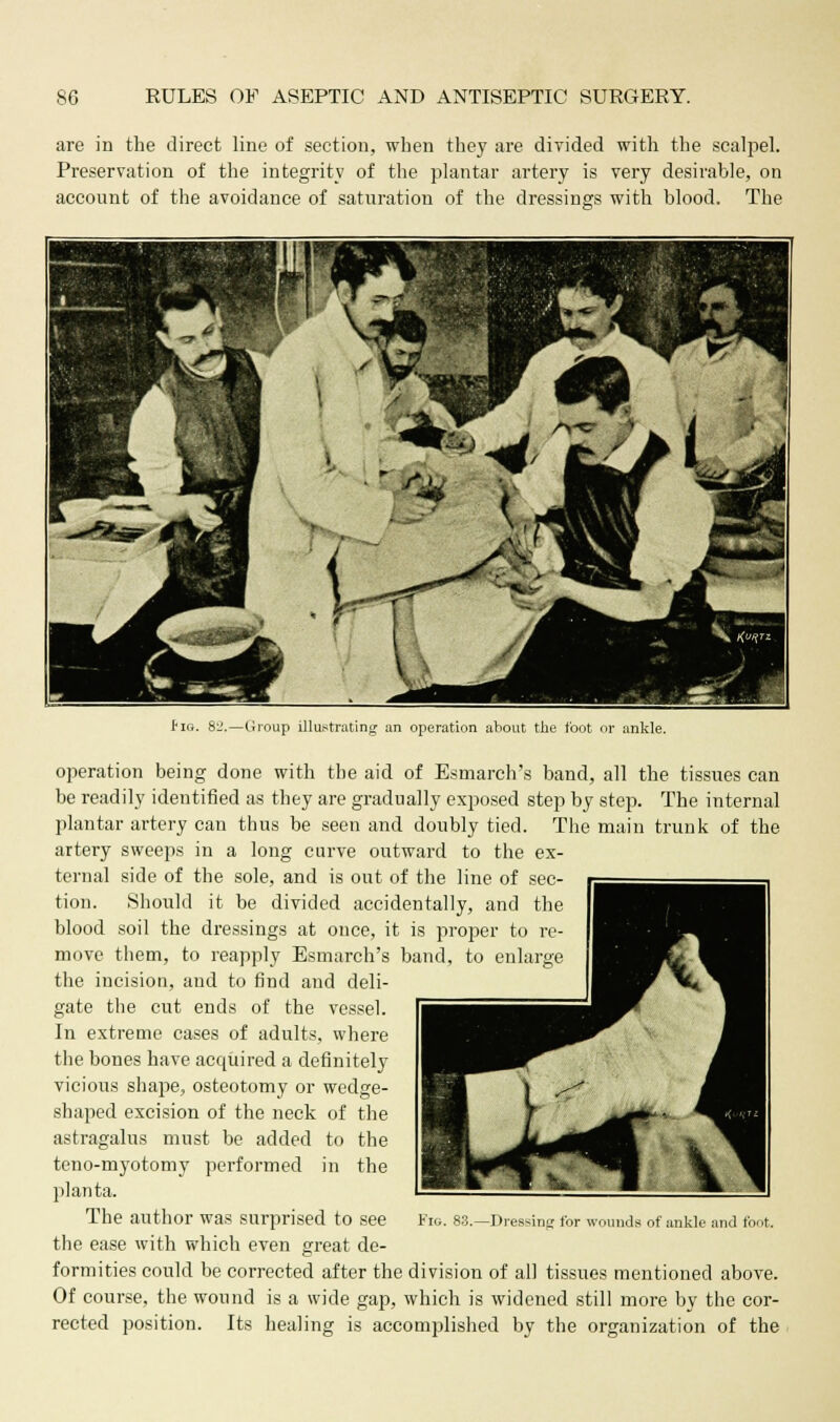 are in the direct line of section, when they are divided with the scalpel. Preservation of the integrity of the plantar artery is very desirable, on account of the avoidance of saturation of the dressings with blood. The Bib. 82,—(iroup illustrating an operation about the foot or ankle. operation being done with the aid of Esmarch's band, all the tissues can be readily identified as they are gradually exposed step by step. The internal plantar artery can thus be seen and doubly tied. The main trunk of the artery sweeps in a long curve outward to the ex- ternal side of the sole, and is out of the line of sec- tion. Should it be divided accidentally, and the blood soil the dressings at once, it is proper to re- move them, to reapply Esmarch's band, to enlarge the incision, and to find and deli- gate the cut ends of the vessel. In extreme cases of adults, where the bones have acquired a definitely vicious shape, osteotomy or wedge- shaped excision of the neck of the astragalus must be added to the teno-myotomy performed in the plant a. the ease with which even great de- formities could be corrected after the division of all tissues mentioned above. Of course, the wound is a wide gap, which is widened still more by the cor- rected position. Its healing is accomplished by the organization of the