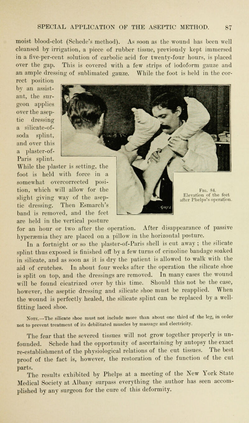 moist blood-clot (Schede's method). As soon as the wound has been well cleansed by irrigation, a piece of rubber tissue, previously kept immersed in a five-per-cent solution of carbolic acid for twenty-four hours, is placed over the gap. This is covered with a few strips of iodoform gauze and an ample dressing of sublimated gauze. While the foot is held in the cor- rect position by an assist- ant, the sur- geon applies over the asep- tic dressing a silicate-of- soda splint. and over this a plaster-of- Fm. 84. Elevation of the feet iter Phelps's operation. Paris splint. While the plaster is setting, the foot is held with force in a somewhat overcorrected posi- tion, which will allow for the slight giving way of the asep- tic dressing. Then Esmarch's band is removed, and the feet are held in the vertical posture for an hour or two after the operation. After disappearance of passive hyperemia they are placed on a pillow in the horizontal posture. In a fortnight or so the plaster-of-Paris shell is cut away ; the silicate splint thus exposed is finished off by a few turns of crinoline bandage soaked in silicate, and as soon as it is dry the patient is allowed to walk with the aid of crutches. In about four weeks after the operation the silicate shoe is split on top, and the dressings are removed. In many cases the wound will be found cicatrized over by this time. Should this not be the case, however, the aseptic dressing and silicate shoe must be reapplied. When the wound is perfectly healed, the silicate splint can be replaced by a well- fitting laced shoe. Note.—The silicate shoe must not include more than about one third of the leg, in order not to prevent treatment of its debilitated muscles by massage and electricity. The fear that the severed tissues will not grow together properly is un- founded. Schede had the opportunity of ascertaining by autopsy the exact re-establishment of the physiological relations of the cut tissues. The best proof of the fact is, however, the restoration of the function of the cut parts. The results exhibited by Phelps at a meeting of the New York State Medical Society at Albany surpass everything the author has seen accom- plished by any surgeon for the cure of this deformity.