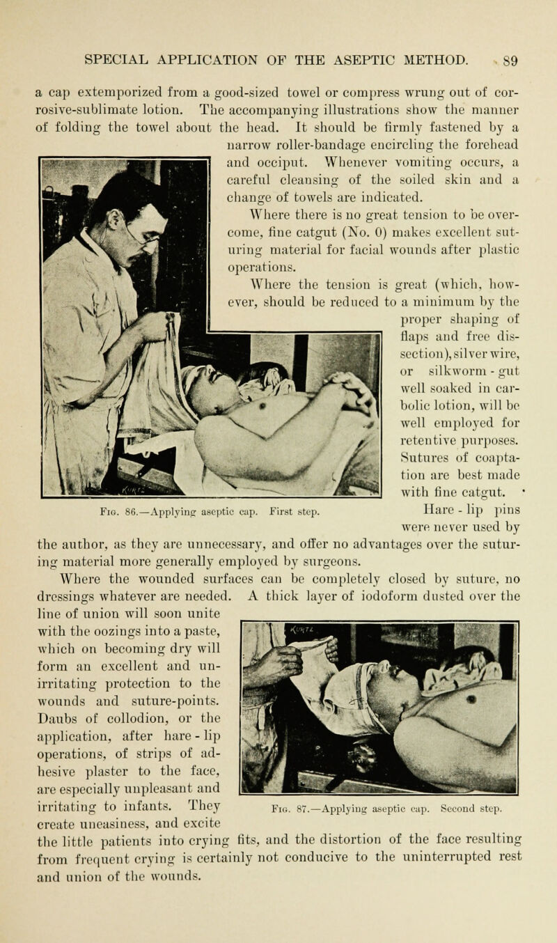 a cap extemporized from a good-sized towel or compress wrung out of cor- rosive-sublimate lotion. The accompanying illustrations show the manner of folding the towel about the head. It should be firmly fastened by a narrow roller-bandage encircling the forehead and occiput. Whenever vomiting occurs, a careful cleansing of the soiled skin and a change of towels are indicated. Where there is no great tension to be over- come, fine catgut (No. 0) makes excellent sut- uring material for facial wounds after plastic operations. Where the tension is great (which, how- ever, should be reduced to a minimum by the proper shaping of flaps and free dis- section), silver wire, or silkworm - gut- well soaked in car- bolic lotion, will be well employed for retentive purposes. Sutures of coapta- tion are best made with fine catgut. Hare - lip pins were never used by the author, as they are unnecessary, and offer no advantages over the sutur- ing material more generally employed by surgeons. Where the wounded surfaces can be completely closed by suture, no dressings whatever are needed. A thick layer of iodoform dusted over the line of union will soon unite with the oozings into a paste, which on becoming dry will form an excellent and un- irritating protection to the wounds and suture-points. Daubs of collodion, or the application, after hare - lip operations, of strips of ad- hesive plaster to the face, are especially unpleasant and irritating to infants. They create uneasiness, and excite the little patients into crying fits, and the distortion of the face resulting from frequent crying is certainly not conducive to the uninterrupted rest and union of the wounds. Applying aseptic cap. Second step.