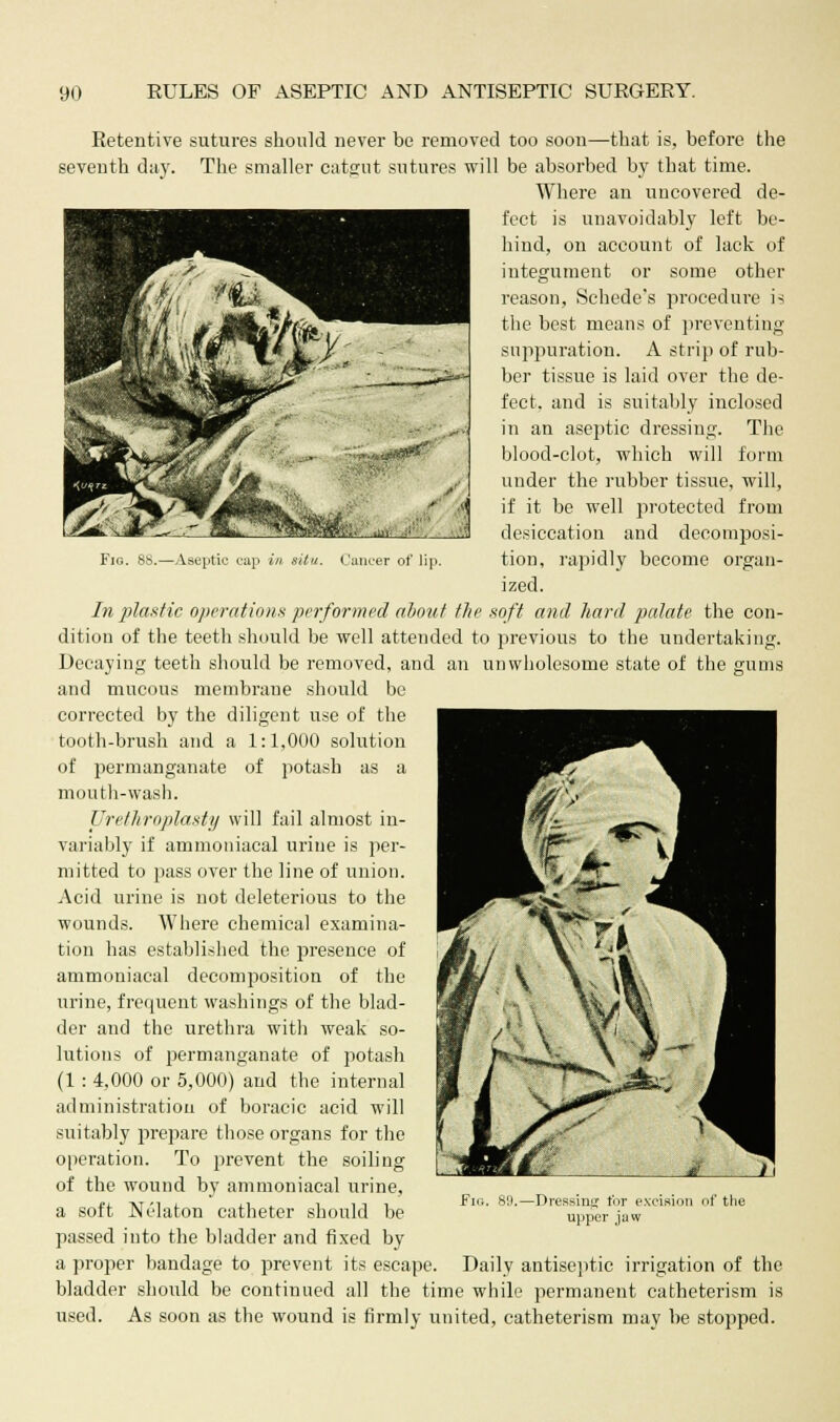 Fig. 88.—Aseptic cap in aitn. Cancer of lip. Retentive sutures should never be removed too soon—that is, before the seventh day. The smaller catgut sutures will be absorbed by that time. Where an uncovered de- fect is unavoidably left be- hind, on account of lack of integument or some other reason, Schede's procedure is the best means of preventing suppuration. A strip of rub- ber tissue is laid over the de- fect, and is suitably inclosed in an aseptic dressing. The blood-clot, which will form under the rubber tissue, will, if it be well protected from desiccation and decomposi- tion, rapidly become organ- ized. In plastic operations performed about the soft and hard palate the con- dition of the teeth should be well attended to previous to the undertaking. Decaying teeth should be removed, and an unwholesome state of the gums and mucous membrane should be corrected by the diligent use of the tooth-brush and a 1:1,000 solution of permanganate of potash as a mouth-wash. Urethroplasty will fail almost in- variably if ammoniacal urine is per- mitted to pass over the line of union. Acid urine is not deleterious to the wounds. Where chemical examina- tion has established the presence of ammoniacal decomposition of the urine, frequent washings of the blad- der and the urethra with weak so- lutions of permanganate of potash (1 : 4,000 or 5,000) and the internal administration of boracic acid will suitably prepare those organs for the operation. To prevent the soiling of the wound by ammoniacal urine, a soft Nelaton catheter should be passed into the bladder and fixed by a proper bandage to prevent its escape. Daily antiseptic irrigation of the bladder should be continued all the time while permanent catheterism is used. As soon as the wound is firmly united, catheterism may be stopped. Fig. 89.- -Dressint; tor excision of the upper jaw