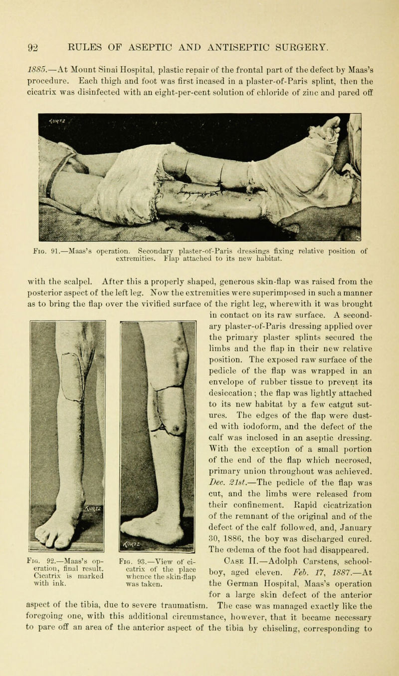 1S85.—At Mount Sinai Hospital, plastic repair of the frontal part of the defect by Maas's procedure. Each thigh and foot was first incased in a plaster-of-Paris splint, then the cicatrix was disinfected with an eight-per-cent solution of chloride of zinc and pared off Fig. 'Jl operation. Secondary plaster-of-Paris dressings fixing relative position of extremities. Flap attached to its new habitat. with the scalpel. After this a properly shaped, generous skin-flap was raised from the posterior aspect of the left leg. Now the extremities were superimposed in such a manner as to bring the flap over the vivified surface of the right leg, wherewith it was brought in contact on its raw surface. A second- ary plaster-of-Paris dressing applied over the primary plaster splints secured the limbs and the flap in their new relative position. The exposed raw surface of the pedicle of the flap was wrapped in an envelope of rubber tissue to prevent its desiccation ; the flap was lightly attached to its new habitat by a few catgut sut- ures. The edges of the flap were dust- ed with iodoform, and the defect of the calf was inclosed in an aseptic dressing. With the exception of a small portion of the end of the flap which necrosed, primary union throughout was achieved. Dec. 21st.—The pedicle of the flap was cut, and the limbs were released from their confinement. Rapid cicatrization of the remnant of the original and of the defect of the calf followed, and, January 30, 188fi, the boy was discharged cured. The oedema of the foot had disappeared. Oase II.—Adolph Carstens, school- boy, aged eleven. Feb. 17, 1887.—At the German Hospital, Maas's operation for a large skin defect of the anterior aspect of the tibia, due to severe traumatism. The case was managed exactly like the foregoing one, with this additional circumstance, however, that it became necessary to pare off an area of the anterior aspect of the tibia by chiseling, corresponding to 92.—Maas's op- eration, final result. Cicatrix is marked with ink. Flo. 93.—View of ci- catrix of the place whence the skin-flap was taken.