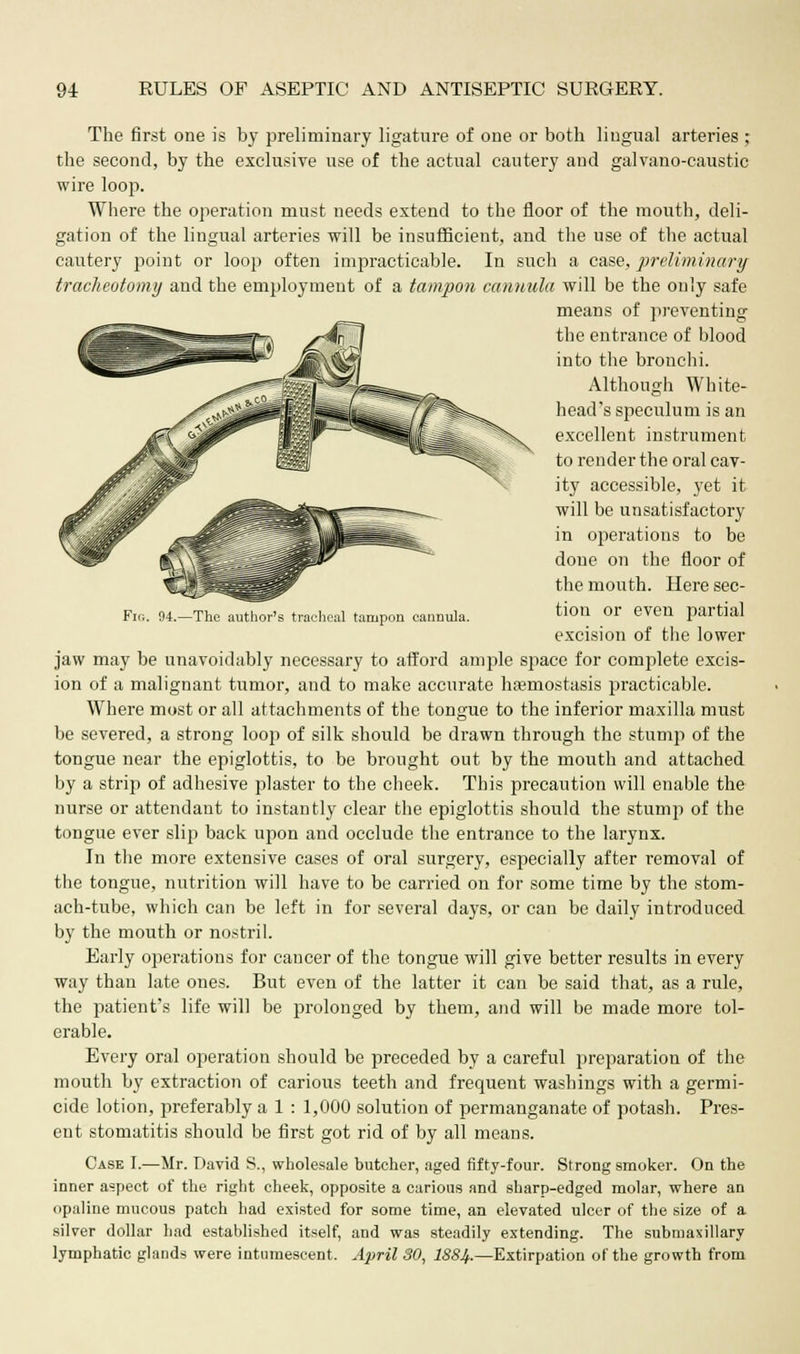 Fig. 94.—The author's tracheal tampon cannula. The first one is by preliminary ligature of one or both lingual arteries ; the second, by the exclusive use of the actual cautery and galvano-caustic wire loop. Where the operation must needs extend to the floor of the mouth, deli- gation of the lingual arteries will be insufficient, and the use of the actual cautery point or loop often impracticable. In such a case, preliminary tracheotomy and the employment of a tampon cannula will be the only safe means of preventing the entrance of blood into the bronchi. Although White- head's speculum is an excellent instrument to render the oral cav- ity accessible, yet it will be unsatisfactory in operations to be done on the floor of the mouth. Here sec- tion or even partial excision of the lower jaw may be unavoidably necessary to afford ample space for complete excis- ion of a malignant tumor, and to make accurate haemostasis practicable. Where most or all attachments of the tongue to the inferior maxilla must be severed, a strong loop of silk should be drawn through the stump of the tongue near the epiglottis, to be brought out by the mouth and attached by a strip of adhesive plaster to the cheek. This precaution will enable the nurse or attendant to instantly clear the epiglottis should the stump of the tongue ever slip back upon and occlude the entrance to the larynx. In the more extensive cases of oral surgery, especially after removal of the tongue, nutrition will have to be carried on for some time by the stom- ach-tube, which can be left in for several days, or can be daily introduced by the mouth or nostril. Early operations for cancer of the tongue will give better results in every way than late ones. But even of the latter it can be said that, as a rule, the patient's life will be prolonged by them, and will be made more tol- erable. Every oral operation should be preceded by a careful preparation of the mouth by extraction of carious teeth and frequent washings with a germi- cide lotion, preferably a 1 : 1,000 solution of permanganate of potash. Pres- ent stomatitis should be first got rid of by all means. Case I.—Mr. David S., wholesale butcher, aged fifty-four. Strong smoker. On the inner aspect of the right cheek, opposite a carious and sharp-edged molar, where an opaline mucous patch had existed for some time, an elevated ulcer of the size of a silver dollar had established itself, and was steadily extending. The submaxillary lymphatic glands were intumescent. April 30, 188J,,.—Extirpation of the growth from