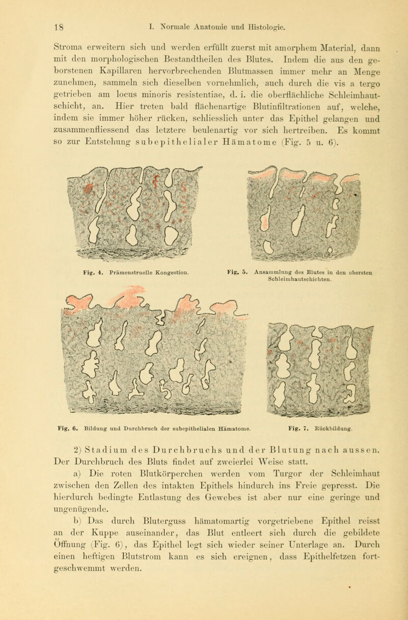 Stroma erweitern sieh und werden erfüllt zuerst mit amorphem Material, dann mit den morphologischen Bestandtheilen des Blutes. Indem die aus den ge- borstenen Kapillaren hervorbrechenden Blutmassen immer mehr an Menge zunehmen, sammeln sich dieselben vornehmlich, auch durch die vis a tergo getrieben am locus minoris resistentiae, d. i. die oberflächliche Schleimhaut- schicht, an. Hier treten bald flächenartige Blutinfiltrationen auf, welche, indem sie immer höher rücken, schliesslich unter das Epithel gelangen und zusammenfliessend das letztere beulenartig vor sich hertreiben. Es kommt so zur Entstehung subepithelialer Hämatome (Fig. 5 u. 6). S? '// •••-'•••> •••■• //, mmmp ; Fig. 4. Prämenstruelle Kongestion. Fig. 5. Ansammlung des Blutes in den obersten Schleimhautschichten. ,J) <& ä Q &f^A -fj^ß, <) : ) ) ■ \i■• 7 *. </f,Vj ■ Fig. 6. Bildung und Durchbruch der subepithelialen Hämatome. Fig. 7. Rückbildung. 2) S t a d i u m des D u r c h b r u c h s u n d der Blut u n g n a c h aussen. Der Durchbruch des Bluts findet auf zweierlei Weise statt. a) Die roten Blutkörperchen werden vom Turgor der Schleimhaut zwischen den Zellen des intakten Epithels hindurch ins Freie gepresst. Die hierdurch bedingte Entlastung des Gewebes ist aber nur eine geringe und ungenügende. b) Das durch Bluterguss hämatomartig vorgetriebene Epithel reisst an der Kuppe auseinander, das Blut entleert sich durch die gebildete Öffnung (Fig. 0), das Epithel legi sich wieder seiner Unterlage an. Durch einen heftigen Blutstrom kann es sich ereignen, dass Epithelfetzen fort- geschwemmt werden.