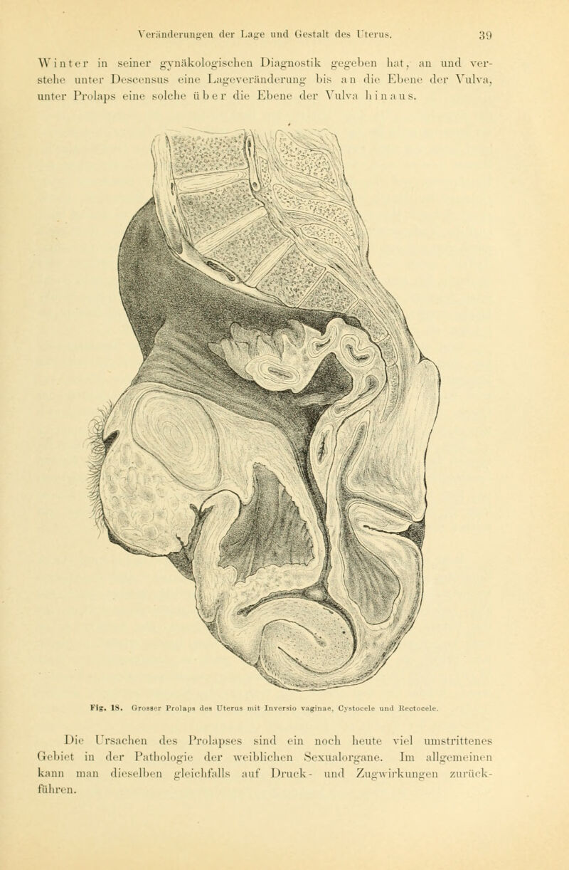 Winter in seiner gynäkologischen Diagnostik gegeben bat, an und ver- stehe unter Descensus eine Lageveränderung l»is an die Ebene der Vulva, unter Prolaps eine solche über die Ebene der Vulva hinaus. Fis. 18. Grosser Prolaps des Uterus mit Inversio väginae, Cystocele and Rectocele. Die Ursachen des Prolapses sind ein noch heute viel umstrittenes Gebiet in der Pathologie der weiblichen Sexualorgane. Im allgemeinen kann man dieselben gleichfalls auf Druck- und Zugwirkungen zurück- fuhren.