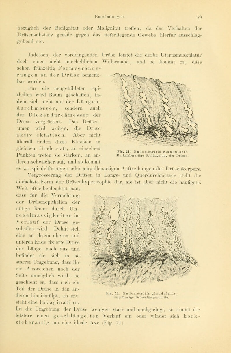 bezüglich der Benignität oder Malignität treffen. da das Verhalten der Drüsensubstanz gerade gegen das tieferliegende Gewebe hierfür ausschlag- gebend sei. ■ if|§ Fiff. 21. Endometritis glandularis. Korkzieherartige Schlängelung der Drüsen. Indessen, der vordringenden Drüse leistet die derbe Uterusmuskulatur doch einen nicht unerheblichen Widerstand, und so kommt es, dass schon frühzeitig Formverände- rungen an der Drüse bemerk- bar werden. Für die neugebildeten Epi- thelien wird Kaum geschaffen, in- dem sieh nicht nur der Längen- durchmesser, sondern auch der Dickendurchmesser der Drüse vergrössert. Das Drüsen- unien wird weiter. die Drüse aktiv ektatisch. Aber nicht überall bilden diese Ektasien in gleichem Grade statt, an einzelnen Punkten treten sie stärker, an an- deren schwächer auf, und so kommt es zu spindelförmigen oder ampullenartigen Auftreibungen des Drüsenkörpers. Vergrösserung der Drüsen in Längs- und Querdurchmesser stellt die einfachste Form der Drüsenhypertrophie dar. sie ist aber nicht die häufigste. Weit öfter beobachtet man. dass für die Vermehrung der Drüsenepithelien der nötige Kaum durch Un- rege 1 m ä ssigkeite n im Verlauf der Drüse ge- schaffen wird. Dehnt sich eine an ihrem oberen und unteren Ende fixierte Drüse der Länge nach aus und befindet sie sich in so starrer Umgebung, dass ihr ein Ausweichen nach der Seite unmöglich wird, so geschieht es, dass sich ein Teil der Drüse in den an- deren hineinstülpl . es ent- steht eine I n v a g i n a t i 0 n. Ist die Umgebung der Drüse weniger starr und nachgiebig, so nimmt die letztere einen geschlängelten Verlauf ein oder windet sich kork- zieherartig Ulli eine ideale Axe Fig. '2\ . m SS?!'*-« / % r v effP i Wh MC ^^ •■<: ■// « w- Fig. ii. Endometritis glandularis. Sägeförmige Drüsenlängsschnitte.
