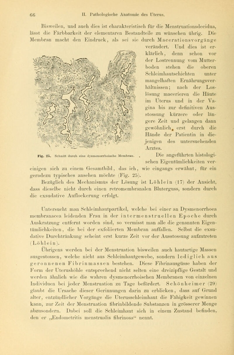 Bisweilen, und auch dies ist charakteristisch für die Menstruationsdecidua, lässt die Färbbarkeit der elementaren Bestandteile zu wünschen übrig. Die Membran macht den Eindruck, als sei sie durch Macerationsvorffänere verändert. Und dies ist er- klärlich , denn schon vor der Lostrennung vom Mutter- boden stehen die oberen Schleimhautschichten unter mangelhaften Ernährungsver- hältnissen; nach der Los- lösung macerieren die Häute im Uterus und in der Va- gina bis zur definitiven Aus- stossung kürzere oder län- gere Zeit und gelangen dann gewöhnlich, erst durch die Hände der Patientin in die- jenigen des untersuchenden Arztes. Die angeführten histologi- schen Eigentümlichkeiten ver- einigen sich zu einem Gesamtbild, das ich, wie eingangs erwähnt, für ein geradezu typisches ansehen möchte (Fig. 25). Bezüglich des Mechanismus der Lösung ist Löhlein (17) der Ansicht, dass dieselbe nicht durch einen retromembranalen Bluterguss, sondern durch die exsudative Auflockerung erfolgt. Fig. 25. Schnitt durch eine dysmenorrhoische Membran. Untersucht man Schleimhautpartikel, welche bei einer an Dysmenorrhoea membranacea leidenden Frau in der intermenstruellen Epoche durch Auskratzung entfernt worden sind, so vermisst man alle die genannten Eigen- tümlichkeiten , die bei der exfoliierten Membran auffallen. Selbst die exsu- dative Durchtränkung scheint erst kurze Zeit vor der Ausstossung aufzutreten (Löhlein). Übrigens werden bei der Menstruation bisweilen auch hautartige Massen ausgestossen, welche nicht aus Schleimhautgewehe, sondern lediglich aus geronnenen Fibrinmassen bestehen. Diese Fibrinausgüsse haben der Form der Uterushöhle entsprechend nicht selten eine dreizipflige Gestalt und werden ähnlich wie die wahren dysmenorrhoischen Membranen von einzelnen Individuen bei jeder Menstruation zu Tage befördert. Schönheimer (29) glaubt die Ursache dieser Gerinnungen darin zu erblicken, dass auf Grund alter, entzündlicher Vorgänge die Uterusschleimhaut die Fähigkeit gewinnen kann, zur Zeit der Menstruation fibrinbildende Substanzen in grösserer Menge abzusondern. Dabei soll die Schleimhaut sich in einem Zustand befinden, den er „Endometritis menstrualis fibrinosa nennt.