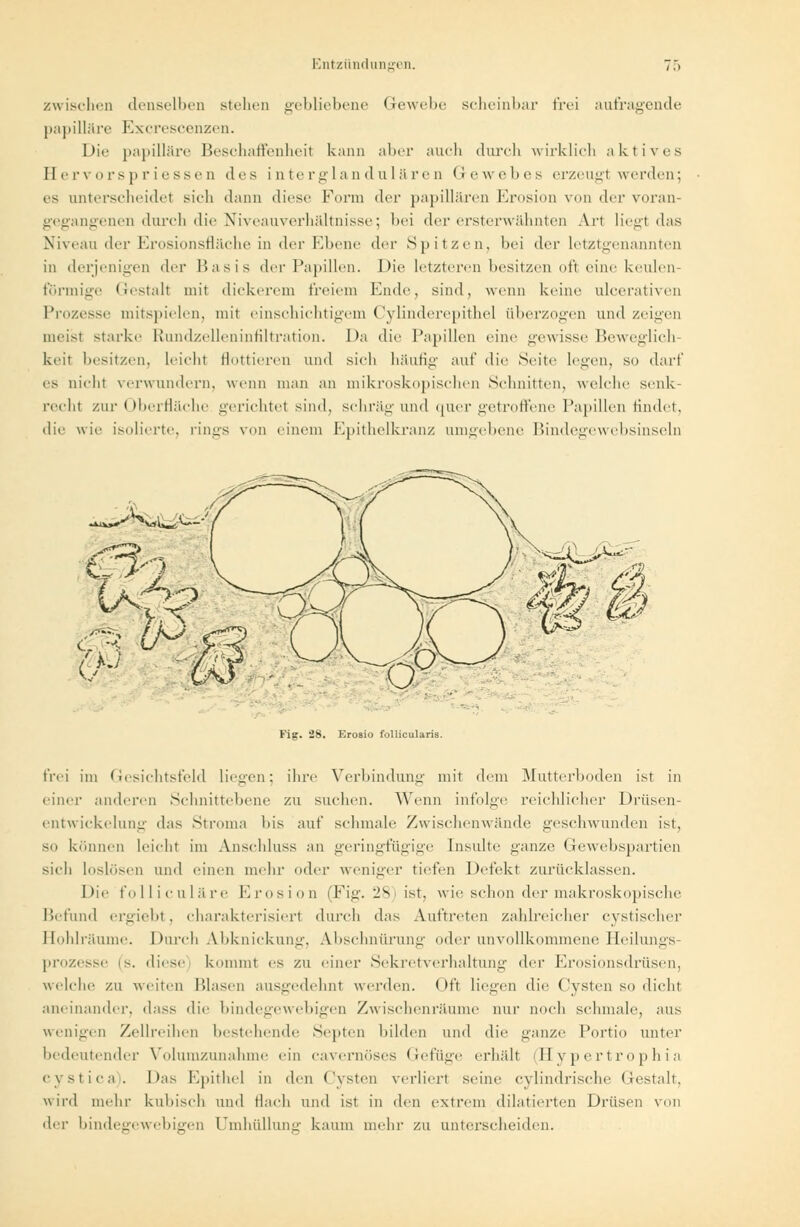 zwischen denselben stehen gebliebene Gewebe scheinbar frei aufragende papilläre Exerescenzen. Die papilläre Beschaffenheit kann aber auch durch wirklich aktives Hervorspriessen des interglandulären Gewebes erzeugt werden; es unterscheidet sieh dann diese Form der papillären Erosion von der voran- gegangenen durch die Niveauverhältnisse; bei der ersterwähnten Art liegl das Niveau der Erosionsfläche in der Ebene drv Spitzen, bei der letztgenannten in derjenigen der Basis der Papillen. Die letzteren besitzen oft eine keulen- förmige Gestalt mit dickerem freiem Ende, sind, wenn keine nlcerativen Prozesse mitspielen, mit einschichtigem Cylinderepithel überzogen und zeigen meist starke Rundzelleninfiltration. Da die Papillen eine gewisse Beweglich- keit besitzen, leicht flottieren und sich häufig auf die Seite legen, so darf es nicht verwundern, wenn man an mikroskopischen Schnitten, welche senk- recht zur Oberfläche gerichtel sind, schräg und quer getroffene Papillen findet, die wie isolierte, rings von einem Epithelkranz umgebene Bindegewebsinseln ■ ■ Fig. 28. Erosio follicularis. frei im Gesichtsfeld liegen; ihre Verbindung mit dem Mutterboden ist in einer anderen Schnittebene zu suchen. Wenn infolge reichlicher Drüsen- entwickelung das Stroma bis auf schmale Zwischenwände geschwunden ist, so können leicht im Anschluss an geringfügige Insulte ganze Gewebspartien sich loslösen und einen mehr oder weniger tiefen Defekt zurücklassen. Die folliculäre Erosion (Fig. 28 ist. wie schon der makroskopische Befund ergiebt, charakterisiert durch das Auftreten zahlreicher cystischer Bohlräume. Durch Atbknickung, Absclmürunir oder unvollkommene Heilungs- prozesse is. diese kommt es zu einer Sekretverhaltung der Erosionsdrüsen, welche zu weiten Blasen ausgedehnt werden. Oft liefen die Cysten so dicht aneinander, dass die bindegewebigen Zwischenräume nur noch schmale, aus wenigen Zellreihen bestehende Septen bilden und die ganze Portio unter bedeutender Volumzunahme ein cavernöses Gefüge erhall (Hypertrophia cystica). Das Epithel in den Cysten verliert seine cylindrischc (Jestalt. wird mehr kuhisch und flach und ist in den extrem dilatierten Drüsen von der bindegewebigen Umhüllung kaum mehr zu unterscheiden.