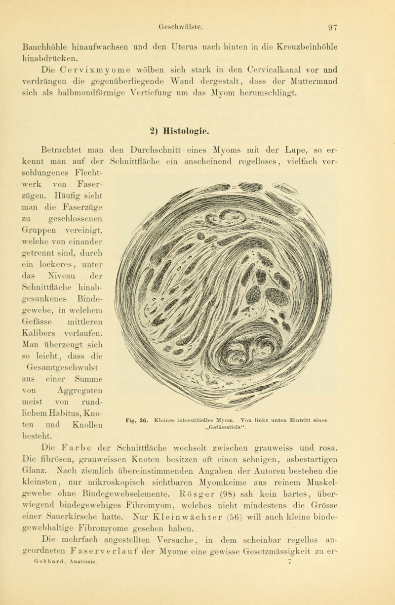 Bauchhöhle hinaufwachscn und den Uterus nach hinten in die Kreuzbeinhöhle hinabdrücken. Die Cervixmyome wölben sich stark in den Cervicalkanal vor und verdrängen die gegenüberliegende Wand dergestalt. dass der Muttermund sieh als halbmondförmige Vertiefung um das Myom herumschlingt. 2) Histologie. Betrachtet man den Durchschnitt eines Myoms mit der Lupe, so er- kennt man auf der Schnittfläche ein anseheinend regelloses, vielfach ver- schlungenes Flecht- werk von Faser- zügen. Häufig sieht man die Faserzüge zu geschlossenen Gruppen vereinigt, welche von einander getrennt sind, durch ein lockeres, anter das Niveau der Schnittfläche hinab- gesunkenes Binde- gewebe, in welchem Grefässe mittleren Kalibers verlaufen, Man überzeugt sich so leicht, dass die Gesamtgeschwulst einer Summe Aggregaten Fig. 36. Kleines interstitielles Myom. Von links unten Eintritt eines ,,Gefässstiels'1. aus von meist von rund- lichem Habitus, Kno- ten und Knollen besteht. Die Kar he der Schnittfläche wechselt zwischen grauweiss und rosa. Die fibrösen, grauweissen Knoten besitzen oft einen sehnigen, asbestartigen Glanz. Nach ziemlich übereinstimmenden Angaben der Autoren bestehen die kleinsten, nur mikroskopisch sichtbaren Myomkeime aus reinem Muskel- gewebe ohne Bindegewebselemente. Rösger (98) sah kein hartes, über- wiegend bindegewebiges Fibromyom, welches nicht mindestens die Grösse einer Sauerkirsche hatte. Nur Kleinwächter (56) will auch kleine binde- gewebhaltige Fibroinyome gesehen haben. Die mehrfach angestellten Versuche, in dem scheinbar regellos an- _ ordneten Faserverlauf der Myome eine gewisse Gesetzmässigkeit zu er- Gebhaid. Anatomie. 7