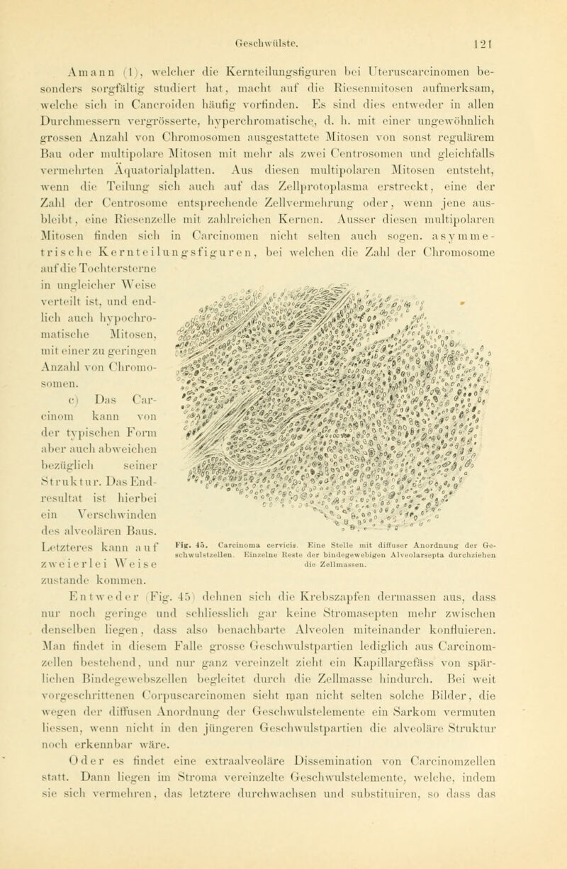 A in ;i 11 n I . welcher «l i * - Kernteilungsfiguren bei Uteruscarcinomen be- sonders sorgfältig studiert hat, macht auf die Riesenmitosen aufmerksam, welche sich in Cancroiden häufig vorfinden. Ks sind dies entweder in allen Durchmessern vergrösserte, hyperchromatische,, d. h. mit einer ungewöhnlich grossen Anzahl von Chromosomen ausgestattete Mitosen von sonst regulärem Mau oder multipolare Mitosen mit mehr als zwei Centrosomen und gleichfalls vermehrten Äquatorialplatten. Aus diesen multipohuvn Mitosen entsteht, wenn die Teilung sieh auch auf das Zellprotoplasma erstreckt, «'ine der Zahl der Centrosome entsprechende Zellvermehrung oder, wenn jene aus- bleibt . eine Riesenzelle mit zahlreichen Kernen. Aussei- diesen multipolaren Mitosen finden sich in Carcinomen nicht selten auch sogen, asymme- trische Kernteilungsfiguren, bei welchen die Zahl der Chromosome auf die Tochter sterne in ungleicher \\ eise verteilt ist. und elld- resultat ist hierbei ' <W&%& ein Verschwinden :>%/a< o,-c^toc' ■■ des alveolären Baus. ° 8-' Letzteres kann a U t *'K° ■ Carcinoma cervicis. Eine Stelle mit diffuser Anordnung der Ge- schwulstzellen. Einzelne Reste der bindegewebigen Alveolarsepta durchziehen zweierlei Weise die Zellmassen. zustande kommen. Entweder Fig. 15 dehnen sich die Krebszapfen dermassen aus, dass nur noch geringe und schliesslich gar keine Stromasepten mehr zwischen denselben liegen, dass also benachbarte Alveolen miteinander konfluieren. Man findet in diesem Falle grosse Geschwulstpartien lediglich aus ('arcinom- zellen bestehend, und nur ganz vereinzelt zieht ein Kapillargefäss von spär- lichen Bindegewebszellen begleitet durch die Zellmasse hindurch. Bei weil vorgeschrittenen Corpuscarcinomen sieht man nicht selten solche Bilder, die wegen der diffusen Anordnung >\''v Geschwulstelemente ein Sarkom vermuten liessen, wenn nicht in den jüngeren Geschwulstpartien die alveoläre Struktur noch erkennbar wäre. Oder es findet eine extraalveoläre Dissemination von Carcinomzellen statt. Dann liegen im Stroma vereinzelte Geschwulstelemente, welche, indem sie sich vermehren, das letztere durchwachsen und substituiren, so dass das