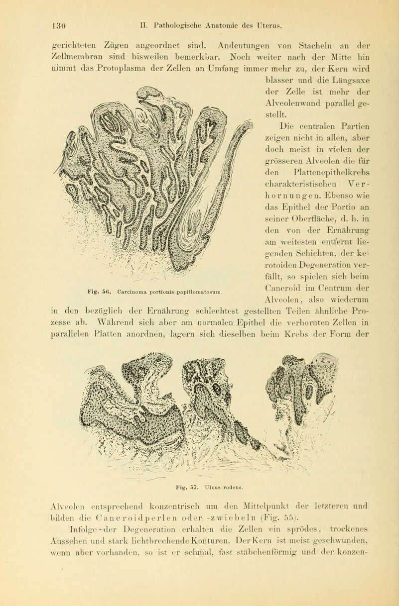 gerichteten Zügen angeordnet sind. Andeutungen von Stacheln an der Zellmembran sind bisweilen bemerkbar. Noch weiter nach der Mitte bin nimmt das Protoplasma der Zellen an Umfang immer mehr zu, der Kern wird blasser und die Längsaxe der Zelle ist mehr der Alveolenwand parallel ge- stellt. Die centralen Partien zeigen nicht in allen, aber doch meist in vielen der grösseren Alveolen die für den Plattenepithelkrebs ebarakteristiseben Ver- hör nun gen. Ebenso wie das Epithel der Portio an seiner Oberfläche, d. h. in den von der Ernährung am weitesten entfernt lie- genden Schichten, der ke- rotoiden Degeneration ver- fällt, so spielen sich beim Cancroid im (Jentrum der Alveolen . also wiederum in den bezüglich der Ernährung schlechtest gestellten Teilen ähnliche Pro- zesse ab. Während sich aber am normalen Epithel die verhornten Zellen in parallelen Platten anordnen, lagern sich dieselben beim Krebs der Form der Fig. 5(>. Carcinoma portiunis papillomatosum. Fig. .>; Ulcus rodens. Alveolen entsprechend konzentrisch um den Mittelpunkt der letzteren und bilden die Cancroidperlen oder -zwiebeln (Fig. 55). Infolge-der Degeneration erhalten die Zellen ein sprödes, trockenes Aussehen und stark lichtbrechende Konturen. Der Kern ist meist geschwunden, wenn aber vorhanden, so ist er schmal, fast stäbchenförmig und der konzen-