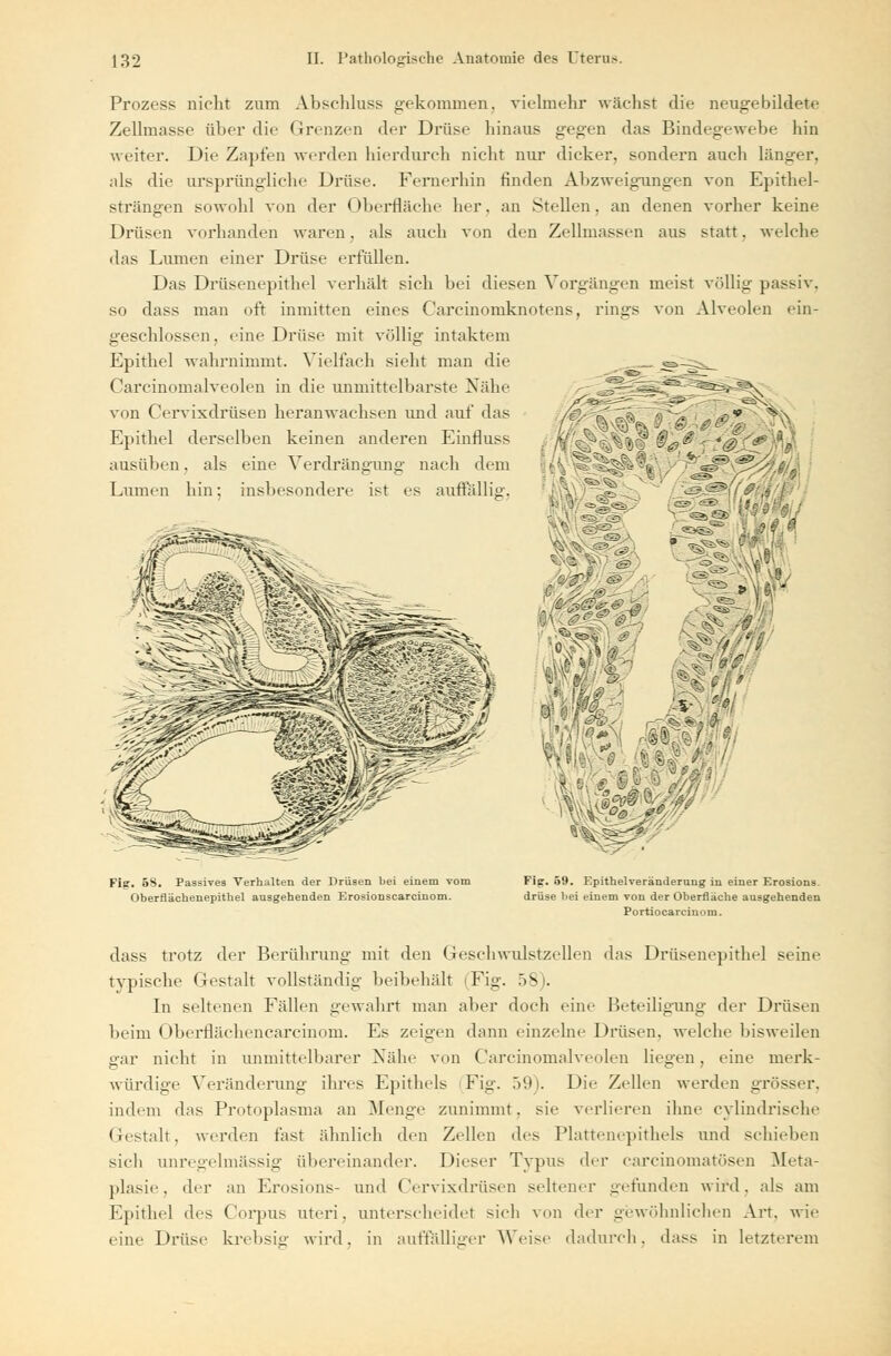 Prozess nicht zum Abschluss gekommen, vielmehr wächst die neugebildete Zellmasse über die Grenzen der Drüse hinaus gegen das Bindegewebe hin weiter. Die Zapfen werden hierdurch nicht nur dicker, sondern auch länger, als die ursprüngliche Drüse. Fernerhin rinden Abzweigungen von Epithel- strängen sowohl von der Oberfläche her. an Stellen, an denen vorher keine Drüsen vorhanden waren, als auch von den Zellmassen aus statt, welche das Lumen einer Drüse erfüllen. Das Drüsenepithel verhält sich bei diesen Vorgängen meist völlig passiv, so dass man oft inmitten eines Carcinomknotens, rings von Alveolen ein- geschlossen, eine Drüse mit völlig intaktem Epithel wahrnimmt. Vielfach sieht man die Carcinomalveolen in die unmittelbarste Nähe von Cervixdrüsen heranwachsen und auf das Epithel derselben keinen anderen Einfluss . -M, \@.*& < *0y&'m£- ausüben. al Lumen hin Fiir. 5S. Passives Verhalten der Drüsen bei einem vom Oberflächenepithel ausgebenden Erosionscarcinom. Fier. 59. Epithelveränderung in einer Erosions. driise bei einem von der Oberfläche ausgehenden Portiocarcinom. dass trotz der Berührung mit den Geschwulstzellen das Drüsenepithel seine typische Gestalt vollständig beibehält 'Fig. 58). In seltenen Fällen gewahrt man aber doch eine Beteiligung der Drüsen beim Oberflächencarcinom. Es zeigen dann einzelne Drüsen, welche bisweilen gar nicht in unmittelbarer Nähe von Carcinomalveolen liegen, eine merk- würdige Veränderung ihres Epithels Fig. 59). Die Zellen werden grösser, indem das Protoplasma an Menge zunimmt, sie verlieren ihne cylindrische Gestalt, werden last ähnlich den Zellen des Plattenepithels und schieben sich unregelmässig übereinander. Dieser Typus der carcinomatösen Meta- plasie, der an Erosions- und Cervixdrüsen seltener gefunden wird, als am Epithel des Corpus uteri, unterscheidet sich von der gewöhnlichen Art. wie eine Drüse krebsig wird, in auffälliger Weise dadurch, dass in letzterem