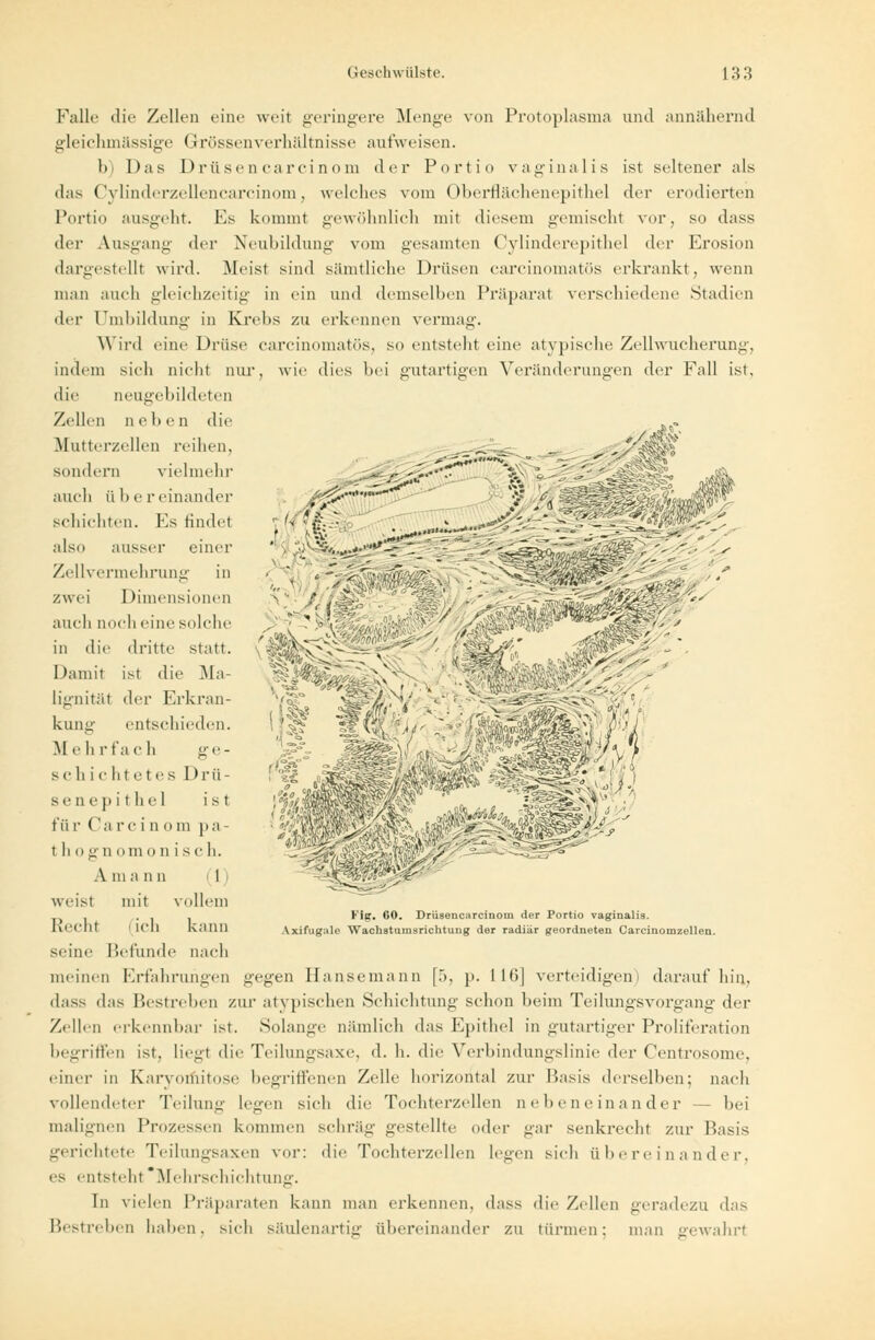 Falle die Zellen eine weit geringere Menge von Protoplasma und annähernd gleichmässige Grössenverhältnisse aufweisen. der Portio vaginalis ist seltener als l)i Das Drüsen earcinom das Oylinderzellenearcinom, welches vom Oberflächenepithel der erodierten Portio ausgeht. Ms kommt gewöhnlich mit diesem gemischt vor, so dass der Ausgang der Neubildung vom gesamten Cylinderepithel der Erosion dargestellt wird. Meist sind sämtliche Drüsen carcinomatös erkrankt, wenn man auch gleichzeitig in ein und demselben Präparat verschiedene Stadien der Umbildung in Krebs zu erkennen vermag. Wird eine Drüse carcinomatös, so entsteht eine atypische Zellwucherung, indem sich nicht nur, wie dies bei gutartigen Veränderungen der Fall ist, die llellgehildcteli Zellen neben die Mutterzellen reihen, sondern vielmehr auch ü I) e reinander schichten. Ks rindet also ausser einer Zellvermehrung in zwei Dimensionen auch noch eine solche in die dritte statt. Damit ist die Ma- > £ Flg. 60. Drüsencarcinoin der Portio vaginalis. Axifugale Wachatumsrichtuug der radiär geordneten Careiuonizellen. lignität drv Erkran- kung entschieden. Mehrfach ge- schichtetes Drü- sen epithel ist fü r Ca rc i n om pa- t h o g n om o n i s c h. A m a im 1 weist mit vollem Recht ■ ich kann seine Befunde nach meinen Erfahrungen gegen Bansemann [5, p. IIB] verteidigen) daraufhin, dass das Bestreben zur atypischen Schichtung schon beim Teilungsvorgang der Zellen erkennbar ist. Solange nämlich das Epithel in gutartiger Proliferation begriffen ist, liegt die Tcilungsaxe, d. h. die Verbindungslinie der Centrosome, einer in Karvoiriitose begriffenen Zelle horizontal zur Basis derselben; nach vollendeter Teilung legen sich die Tochterzellen nebeneinander - bei malignen Prozessen kommen schräg gestellte oder gar senkrecht zur Basis gerichtete Teilungsaxen vor: die Tochterzellen legen sich übereinander. es entsteht Mehrschichtung. In vielen Präparaten kann man erkennen, dass die Zellen geradezu das Bestreben haben, sich säulenartig übereinander zu türmen; man gewahrt
