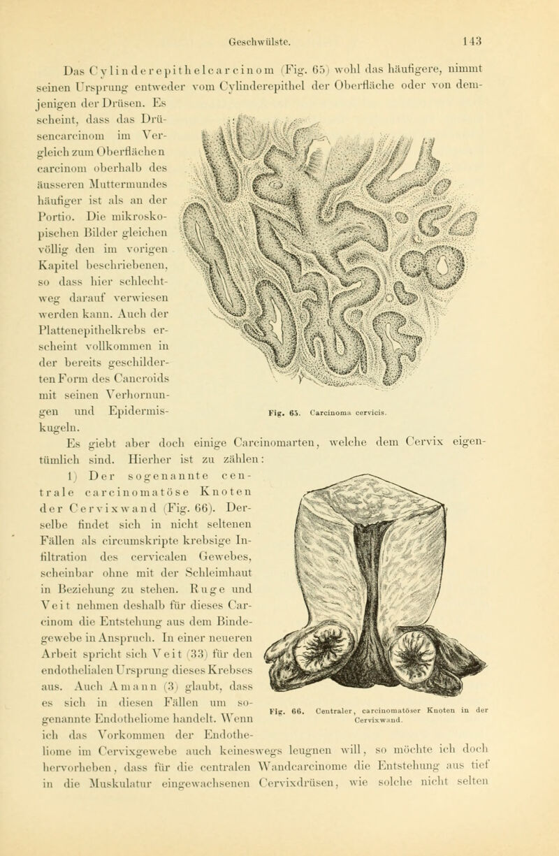 Das Cylinderepithelcarcinom (Fig. 65) wohl .las häutigere, nimmt seinen Ursprung entweder vom Cylinderepithel der Oberfläche oder von dem- jenigen der Drüsen. Es scheint, dass das Drii- sencarcinom im Ver- gleich zum (Iberflächen carcinom oberhalb des äusseren Muttermundes häufiger ist als an der m •'.*•'• l-ti A«;>- $.:'.'•'.3$ •><. %-••'■ Fig. 63. Carcinoma cervicis. Portio. Die mikrosko- pischen Bilder gleichen völlig den im vorigen Kapitel beschriebenen, so dass hier schlecht- weg darauf verwiesen werden kann. Auch der Plattenepithelkrebs er- scheint vollkommen in der bereits geschilder- ten Form des Cancroids mit seinen Verhornun- gen und Epidermis- kngeln. Es giebt aber doch einige Carcinomarten, welche dem Cervix eigen- tümlich sind. Hierher ist zu zählen: 1) Der sogenannte cen- trale carcinomatöse Knoten der Cervix wand Fig. 66). Der- selbe findet sich in nicht seltenen Fidlen als circumskripte krebsige In- filtration des cervicalen Gewebes, Scheinbar ohne mit der Schleimhaut in Beziehung zu stehen. Rüge und Veit nehmen deshalb für dieses Car- cinom die Entstehung aus dem Binde- gewehe in Anspruch. In einer neueren Arbeit spricht sich Veit (33) für den endothelialen Ursprung dieses Krebses aus. Auch Amann (3) glaubt, dass es sich in diesen Fällen um so- genannte Endotheliome handelt. Wenn ich «las Vorkommen der Endothe- liome im Cervixgewebe auch keineswegs leugnen will, so möchte ich doch hervorheben, dass für die centralen Wandcarcinome die Entstehung aus kiel in die Muskulatur eingewachsenen Cervixdrüsen, wie solche nichl sehen Fig. 0«. Centraler, careinomatöäer Knoten in der Cervixwaud.