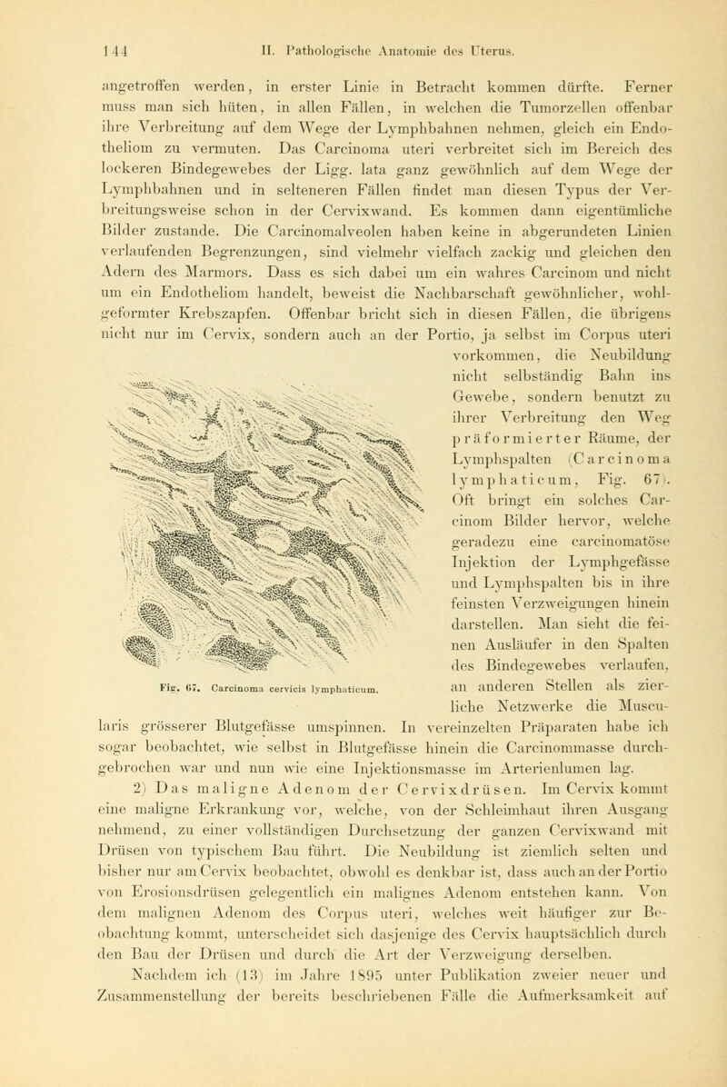 «ääS .. -- \*. V ; - %, ?|i». saüSÜs M^ ■*Sv;aBj *© ' ^etü m SSt angetroffen werden, in erster Linie in Betracht kommen dürfte. Ferner muss man sich hüten, in allen Fällen, in welchen die Tumorzellen offenbar ihre Verbreitung auf dem Wege der Lymphbahnen nehmen, gleich ein Endo- theliom zu vermuten. Das Carcinoma uteri verbreitet sich im Bereich des lockeren Bindegewebes der Ligg. lata ganz gewöhnlich auf dem Wege der Lymphbahnen und in selteneren Fällen rindet man diesen Typus der Ver- breitungsweise schon in der Cervixwand. Es kommen dann eigentümliche Bilder zustande. Die Carcinomalveolen haben keine in abgerundeten Linien verlaufenden Begrenzungen, sind vielmehr vielfach zackig und gleichen den Adern des Marmors. Dass es sich dabei um ein wahres Carcinom und nicht um ein Endotheliom handelt, beweist die Nachbarschaft gewöhnlicher, wohl- geformter Krebszapfen. Offenbar bricht sich in diesen Fällen, die übrigens nicht nur im Cervix, sondern auch an der Portio, ja selbst im Corpus uteri vorkommen, die Neubildung nicht selbständig Bahn ins Gewebe, sondern benutzt zu ihrer Verbreitung den Weg präformierter Räume, der Lymphspalten Carcinoma 1 y m p h a t i c u m , Fig. 67. Oft bringt ein solches Car- cinom Bilder hervor, welche geradezu eine carcinomatöse Injektion der Lymphgefässe und Lymphspalten bis in ihre feinsten Verzweigungen hinein darstellen. Man sieht die fei- nen Ausläufer in den Spalten des Bindegewebes verlaufen, an anderen Stellen als zier- liche Netzwerke die Muscu- laris grösserer Blutgefässe umspinnen. In vereinzelten Präparaten habe ich sogar beobachtet, wie selbst in Blutgefässe hinein die Carcinommasse durch- gebrochen war und nun wie eine Injektionsmasse im Arterienlumen lag. 2) Das maligne Adenom der Cervixdrüsen. Im Cervix kommt eine maligne Erkrankimg vor, welche, von der Schleimhaut ihren Ausgang nehmend, zu einer vollständigen Durchsetzung der ganzen Cervixwand mit Drüsen von typischem Bau führt. Die Neubildung ist ziemlich selten und bisher nur am Cervix beobachtet, obwohl es denkbar ist, dass auch ander Portio von Erosionsdrüsen gelegentlich ein malignes Adenom entstehen kann. Von dem malignen Adenom des Corpus uteri, welches weit häutiger zur Be- obachtung kommt, unterscheidet sich dasjenige des Cervix hauptsächlich durch den Bau der Drüsen und durch die Art der Verzweigung derselben. Nachdem ich (13) im Jahre 1895 unter Publikation zweier neuer und Zusammenstelluno- der bereits beschriebenen Fidle die Aufmerksamkeit auf Fifr. 67. Carcinoma cervicis lymphuticum.
