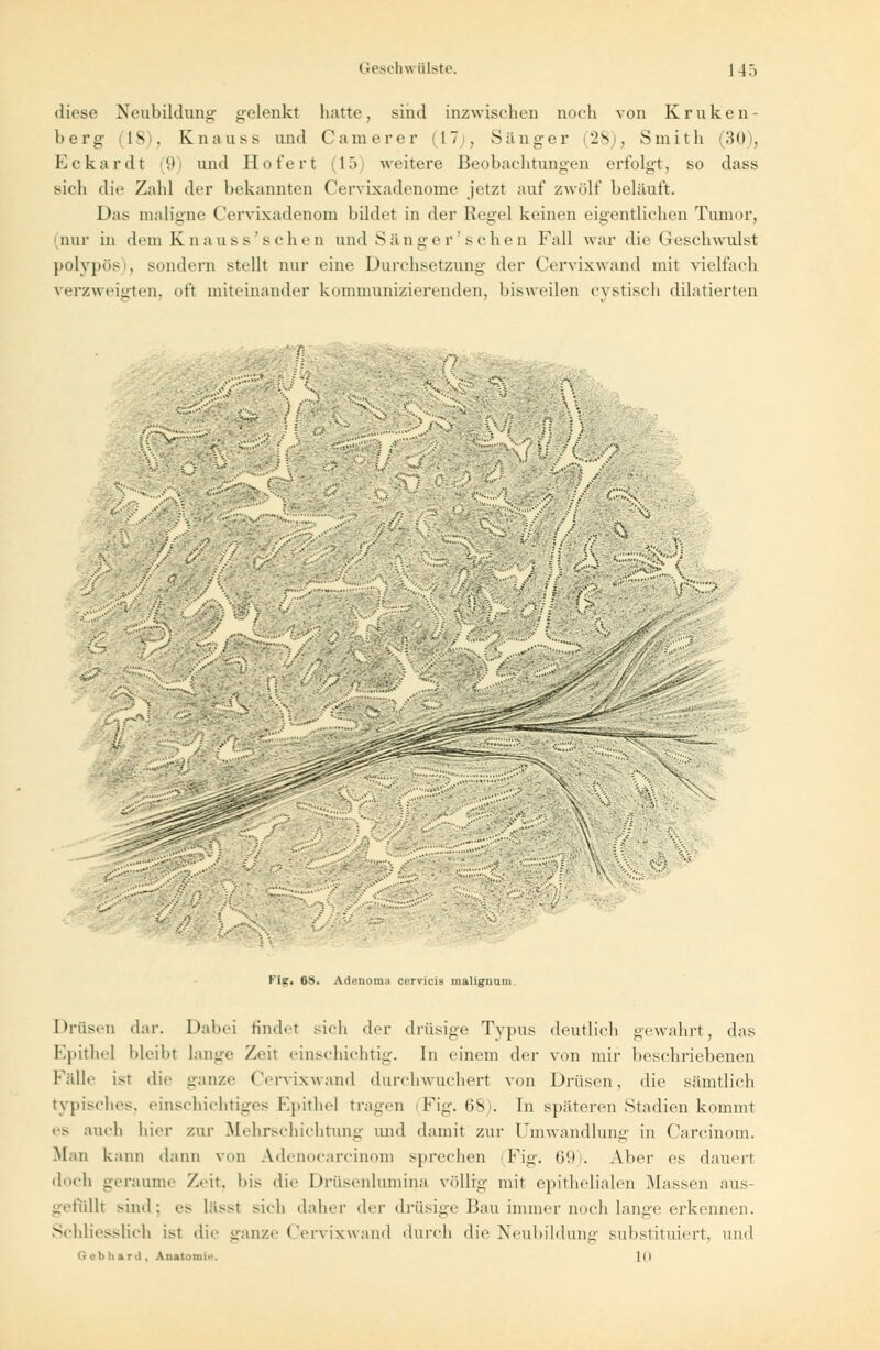 diese Neubildung- gelenkt hatte, sind inzwischen noch von Kruken- berg (18), Knauss und Camerer (17 . Sänger (28), Smith (30), Eckardt 9) und Hofert (15 weitere Beobachtungen erfolgt, so dass sich die Zahl der bekannten Cervixadenome jetzt auf zwölf belauft. Das maligne Cervixadenom bildet in der Regel keinen eigentlichen Tumor, nur in dem Knauss'schen and Sänger'sehen Fall war die Geschwulst polypös), sondern stellt nur eine Durchsetzung der Cervixwand mit vielfach verzweigten, oft miteinander kommunizierenden, bisweilen cystisch dilatierten • n ',-* :■ : '•'-' f\ *ür ,... \- Fisr. 68. Adenoma cervicis maliguui Drüsen dar. Dabei findet sich der drüsige Typus deutlich gewahrt, das Epithel bleibt lange Zeit einschichtig. In einem der von mir beschriebenen Fälle ist die ganze Cervixwand durcliwucliert von Drüsen, die sämtlich typisches, einschichtiges Epithel tragen Fig. (>Si. In späteren Stadien kommt es auch hier zur Mehrschichtung und damit zur Umwandlung in Carcinom. Man kann dann von Adenocarcinom sprechen (Fig. 69). Aber es dauert doch geraume Zeit, bis die Drüsenlumina völlig mit epithelialen Massen aus- gefüllt sind: es lässt sich daher der drüsige Bau immernoch lange erkennen. Schliesslich ist die ganze Cervixwand durch die Neubildung substituiert, und Gebhard, Anatomie. ]o