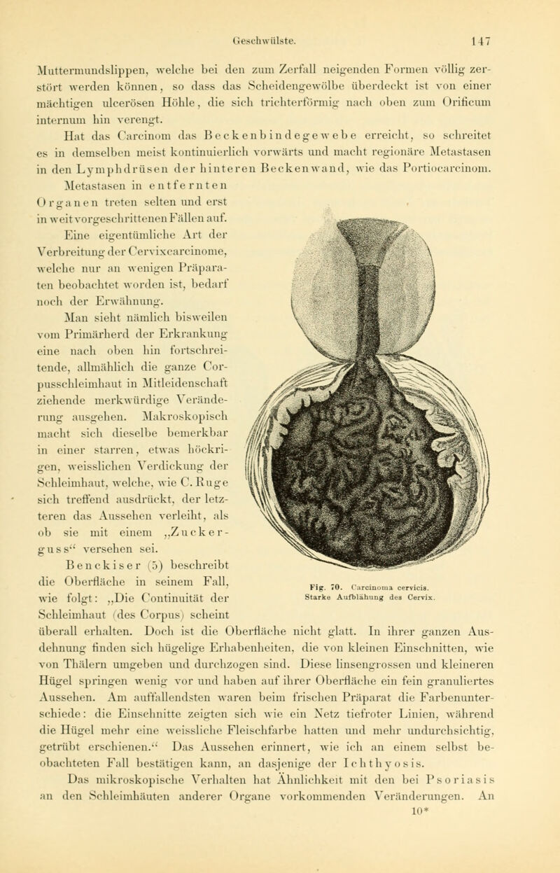 ■Mi Muttermundslippen, welche bei den zum Zerfall neigenden Formen völlig zer- stört werden können, so dass das Scheidengewölbe überdeckt ist von einer mächtigen ulcerösen Höhle, die sich trichterförmig nach oben zum Orificum intcrnum hin verengt. Hat das Carcinom das Beckenbindegewebe erreicht, so schreitet es in demselben meist kontinuierlich vorwärts und macht regionäre Metastasen in den Lymphdrüsen der hinteren Beckenwand, wie das Portiocarcinom. Metastasen in entfernten Organen treten selten und erst in weit vorgeschrittenen Fidlen auf. Eine eigentümliche Art der Verbreitung der Cervixcarcinome, welche nur an wenigen Präpara- ten beobachtet worden ist, bedarf noch der Erwähnung. Man sieht nämlich bisweilen vom Primärherd der Erkrankung eine nach oben hin fortschrei- tende, allmählich die ganze Cor- pusschleimhaut in Mitleidenschaft ziehende merkwürdige Verände- rung ausgehen. Makroskopisch macht sich dieselbe bemerkbar in einer starren, etwas höckri- gen, weisslichen Verdickung der Schleimhaut, welche, wie C. Rüge sich treffend ausdrückt, der letz- teren das Aussehen verleiht, als ob sie mit einem „Zucker- guss-- versehen sei. Benckiser 1..>) beschreibt die Oberfläche in seinem Fall, wie folgt: „Die Continuität der Schleimhaut 1 des Corpus) scheint überall erhalten. Doch ist die Oberfläche nicht glatt. In ihrer ganzen Aus- dehnung finden sich hügelige Erhabenheiten, die von kleinen Einschnitten, wie von Thälern umgeben und durchzogen sind. Diese linsengrossen und kleineren Hügel springen wenig vor und haben auf ihrer Oberfläche ein fein granuliertes Aussehen. Am auffallendsten waren beim frischen Präparat die Farbenunter- schiede : die Einschnitte zeigten sich wie ein Netz tiefroter Linien, während die Hügel mehr eine weissliche Fleischfarbe hatten und mehr undurchsichtig, getrübt erschienen. Das Aussehen erinnert, wie ich an einem selbst be- obachteten Fall bestätigen kann, an dasjenige der Ichthyosis. Das mikroskopische Verhalten hat Ähnlichkeit mit den bei Psoriasis an den Schleimhäuten anderer Organe vorkommenden Veränderungen. An Fig. 70. Carcinoma cervicis. Starke Aufblähung des Cervix.