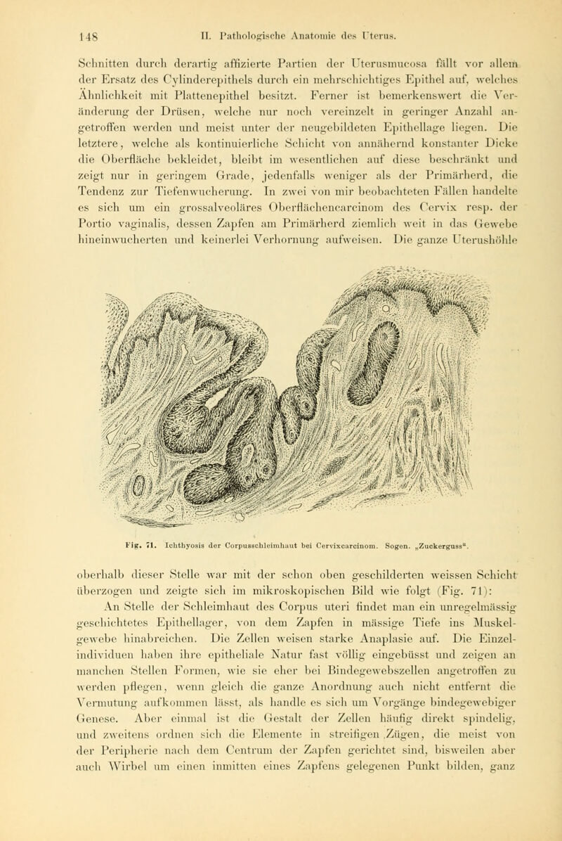 Schnitten durch derartig affizierte Partien der Uterusmucosa fällt vor allem der Ersatz des Cylinderepithels durch ein mehrschichtiges Epithel auf. welches Ähnlichkeit mit Plattenepithel besitzt. Ferner ist bemerkenswert die Ver- änderung der Drüsen, welche nur noch vereinzelt in geringer Anzahl an- getroffen werden und meist unter der neugebildeten Epithellage liegen. Die letztere, welche als kontinuierliche Schicht von annähernd konstanter Dicke die Oberfläche bekleidet, bleibt im wesentlichen auf diese beschränkt und zeigt nur in geringem Grade, jedenfalls weniger als der Primärherd, die Tendenz zur Tiefenwucherung. In zwei von mir beobachteten Fällen handelte es sich um ein grossalveoläres Oberflächencarcinom des Cervix resp. der Portio vaginalis, dessen Zapfen am Primärherd ziemlich weit in das Gewebe hineinwucherten und keinerlei Verhornung aufweisen. Die ganze Uterushöhle m dB Fig. 71. Ichthyosis der Corpusschlcimhaut bei Cervixcarcinom. Sogen. „Zuckerguss. oberhalb dieser Stelle war mit der schon oben geschilderten weissen Schicht überzogen und zeigte sich im mikroskopischen Bild wie folgt (Fig. 71): An Stelle der Schleimhaut des Corpus uteri findet man ein unregelmässig geschichtetes Epithellager, von dem Zapfen in massige Tiefe ins Muskel- gewebe hinabreichen. Die Zellen weisen starke Anaplasie auf. Die Einzel- individuen haben ihre epitheliale Natur fast völlig eingebüsst und zeigen an manchen Stellen Formen, wie sie eher bei Bindegewebszellen angetroffen zu werden pflegen, wenn gleich die ganze Anordnung auch nicht entfernt die Vermutung aufkommen lässt, als handle es sich um Vorgänge bindegewebiger Genese. Aber einmal ist die Gestalt der Zellen häufig direkt spindelig. und zweitens ordnen sich die Elemente in streifigen .Zügen, die meist von der Peripherie nach dem Centrum der Zapfen gerichtet sind, bisweilen aber auch Wirbel um einen inmitten eines Zapfens gelegenen Punkt bilden, ganz