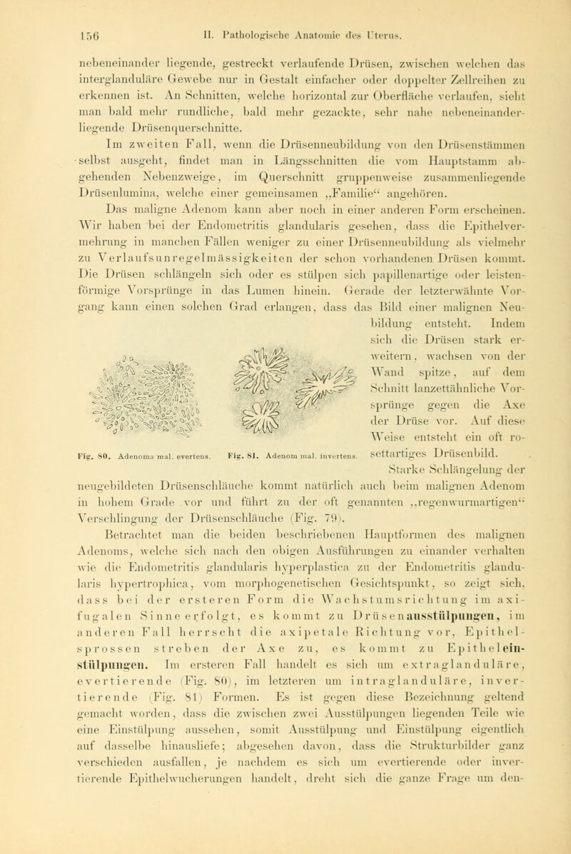 nebeneinander liegende, gestreckt verlaufende Drüsen, zwischen welchen das interglanduläre Gewebe nur in Gestalt einfacher oder doppelter Zollreihen zu erkennen ist. An Schnitten, welche horizontal zur Oberfläche verlauten, sieht man bald mehr rundliche, bald mehr gezackte, sehr nahe nebeneinander- liegende Drüsenquerschnitte. Im zweiten Fall, wenn die Drüsenneubildung von den Drüsenstämmen •selbst ausgeht, rindet man in Längsschnitten die vom Hauptstamm ab- gehenden Nebenzweige, im Querschnitt gruppenweise zusammenhegende Drüsenlumina, welche einer gemeinsamen „Familie angehören. Das maligne Adenom kann aber noch in einer anderen Form erscheinen. Wir haben bei der Endometritis glandularis gesehen, dass die Epithelver- mehrung in manchen Fidlen weniger zu einer Drüsenneubildung als vielmehr zu Verlaufsunregelmässigkeiten der schon vorhandenen Drüsen kommt. Die Drüsen schlängeln sich oder es stülpen sich papülenartige oder kasten- förmige Vorsprünge in das Lumen hinein. Gerade der letzterwähnte Vor- gang kann einen solchen Grad erlangen, dass das Bild einer malignen Neu- bildung entsteht. Indem sich die Drüsen stark er- weitern . wachsen von der Wand spitze, auf dem Schnitt lanzettähnliche Vor- sprünge gegen die Axe der Drüse vor. Auf diese Weise entsteht ein oft ro- settartiges Drüsenbild. Starke Schlängelung der . - :,^ t -:, --t^Ps-H - m Fig. 80. Adenoma mal. everteus. SM Flg. Sl. Adenom mal. invertens. neugebildeten Drüsenschläuche kommt natürlich auch beim malignen Adenom in hohem Grade vor und führt zu der oft genannten ,,regenwurmartigen Verschlingung der Drüsenschläuche (Fig. 79). Betrachtet man die beiden beschriebenen Hauptformen des malignen Adenoms, welche sich nach den obigen Ausführungen zu einander verhalten wie die Endometritis glandularis hyperplastica zu der Endometritis glandu- laris hypertrophica, vom morphogenetischen Gesichtspunkt, so zeigt sich. dass bei der erste reu Form die Wachstumsrichtung im axi- fugalen Sinne erfolgt, es kommt zu Drüsenausstülpungen, im anderen Fall herrscht die axipetale Richtung vor. Epithel- sprossen streben der Axe zu. es kommt zu Fpithelein- stülpnngen. Im ersteren Fall handelt es sich um extraglanduläre, evertierende (Fig. 80), im letzteren um intraglanduläre, inver- tierende (Fig. 81) Formen. Es ist gegen diese Bezeichnung geltend gemacht worden, dass die zwischen zwei Ausstülpungen liegenden Teile wie eine Einstülpung aussehen, somit Ausstülpung und Einstülpung eigentlich auf dasselbe hinausliefe; abgesehen davon, dass die Strukturbilder ganz verschieden ausfallen . je nachdem es sich um evertierende oder inver- tierende Epithelwucherungen handelt, dreht sich die ganze Frage um den-