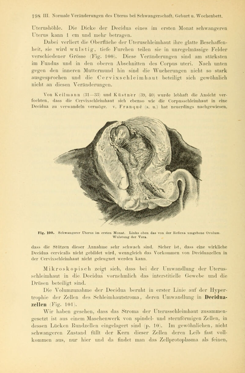 Uterushöhle. Die Dicke der Decidua eines im ersten Monat schwangeren Uterus kann 1 cm und mehr betragen. Dabei verliert die Oberfläche der Utenischleimhaut ihre glatte Beschaffen- heit, sie wird wulstig, tiefe Furchen teilen sie in unregelmässige Felder verschiedener Grösse (Fig. L00). Diese Veränderungen sind am stärksten im Fundus und in den oberen Abschnitten des Corpus uteri. Nach unten gegen den inneren Muttermund hin sind die Wucherungen nicht so stark ausgesprochen und die Cervixschleimhaut beteiligt sich gewöhnlich nicht an diesen Veränderungen. Von Keilmann (31—33) und Küstner (39, 40) wurde lebhaft die Ansicht ver- fochten, dass die Cervixschlehnhaut sieh ebenso wie die Corpusschleimhaut in eine Decidua zu verwandeln vermöge, v. Franque (s. u.) hat neuerdings nachgewiesen, Fig. 100. Schwangerer Uterus im ersten Monat. Links oben das von der Reüexa umgebene Ovulum. Wulstung der Vera. dass die Stützen dieser Annahme sehr schwach sind. Sicher ist. dass eine wirkliche Decidua cervicalis nicht gebildet wird, wenngleich das Vorkommen von Deciduazellen in der Cervixschleimhant nicht geleugnet werden kann. Mikroskopisch zeigt sich, dass bei der Umwandlung der Uterus- schleimhaut in die Decidua vornehmlich das interstitielle Gewehe und die Drüsen beteiligt sind. Die Volumzunahme der Decidua beruht in erster Linie auf der Hyper- trophie der Zellen des Schleimhaütstroma, deren Umwandlung in Decidua- zellen Fig. 101). Wir haben gesehen, dass das Stroma der Uterusschleimhaut zusammen- gesetzt ist aus einem Maschenwerk von Spindel- und sternförmigen Zellen, in dessen Lücken Rundzellen eingelagert sind p. 10). Im gewöhnlichen, nicht schwangeren Zustand füllt der Kern dieser Zellen deren Leib fast voll- kommen aus. nur hier und da findet man das Zellprotoplasma als feinen.