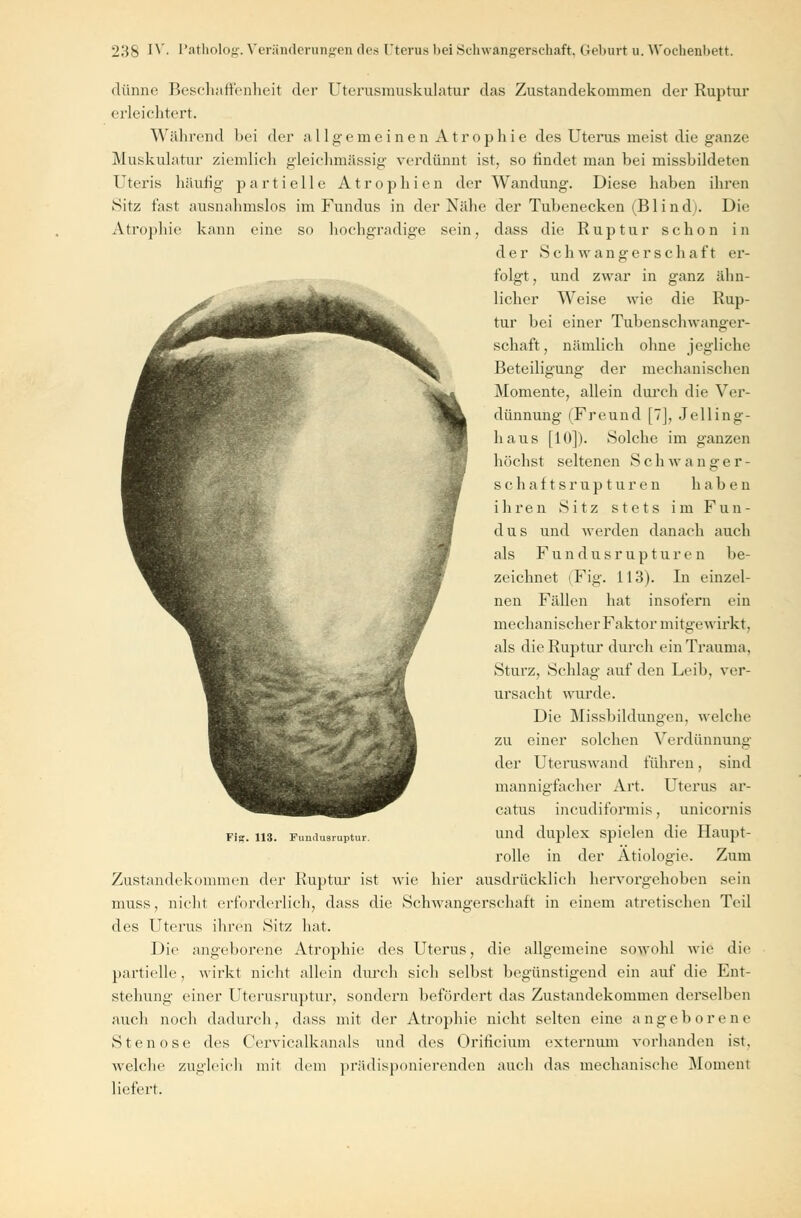 dünne Beschaffenheit der Uterusmuskulatur das Zustandekommen der Ruptur erleichtert. Während bei der allgemeine n A t r o p h i e des Uterus meist die ganze Muskulatur ziemlieh gleichmässig verdünnt ist, so rindet man bei missbildetcn Uteris häufig partielle Atrophien der Wandung. Diese haben ihren Sitz fast ausnahmslos im Fundus in der Nähe der Tubenecken (Blind. Die Atrophie kann eine so hochgradige sein, dass die Ruptur schon in der Schwangerschaft er- folgt, und zwar in ganz ähn- licher Weise wie die Rup- tur bei einer Tubenschwanger- schaft, nämlich ohne jegliche Beteiligung der mechanischen Momente, allein durch die Ver- dünnung (Freuud [7], Jelling- haus [10]). Solche im ganzen höchst seltenen S c h w a n g e r - s c h a f t s r u p t u r e n haben ihren Sitz stets im Fun- dus und werden danach auch als F u n d u s r u p t u r e n be- zeichnet (Fig. 113). In einzel- nen Fällen hat insofern ein mechanischer Faktor mitgewirkt, als die Ruptur durch ein Trauma. Sturz, Schlag auf den Leib, ver- ursacht wurde. Die Missbildungen, welche zu einer solchen Verdünnung der Uteruswand führen, sind mannigfacher Art. Uterus ar- catus incudiformis. unicornis und duplex spielen die Haupt- rolle in der Ätiologie. Zum Zustandekommen der Ruptur ist wie hier ausdrücklich hervorgehoben sein muss, nicht erforderlich, dass die Schwangerschaft in einem atretischen Teil des Uterus ihren Sitz hat. Die angeborene Atrophie des Uterus, die allgemeine sowohl wie die partielle, wirkt nicht allein durch sich selbst begünstigend ein auf die Ent- stehung einer Uterusruptur, sondern befördert das Zustandekommen derselben auch noch dadurch, dass mit der Atrophie nicht selten eine angeborene Stenose des Cervicalkanals und des Orificium externum vorhanden ist. welche zugleich mit dem prädisponierenden auch das mechanische Moment liefert. Fi«. 113. Fundusruptur.