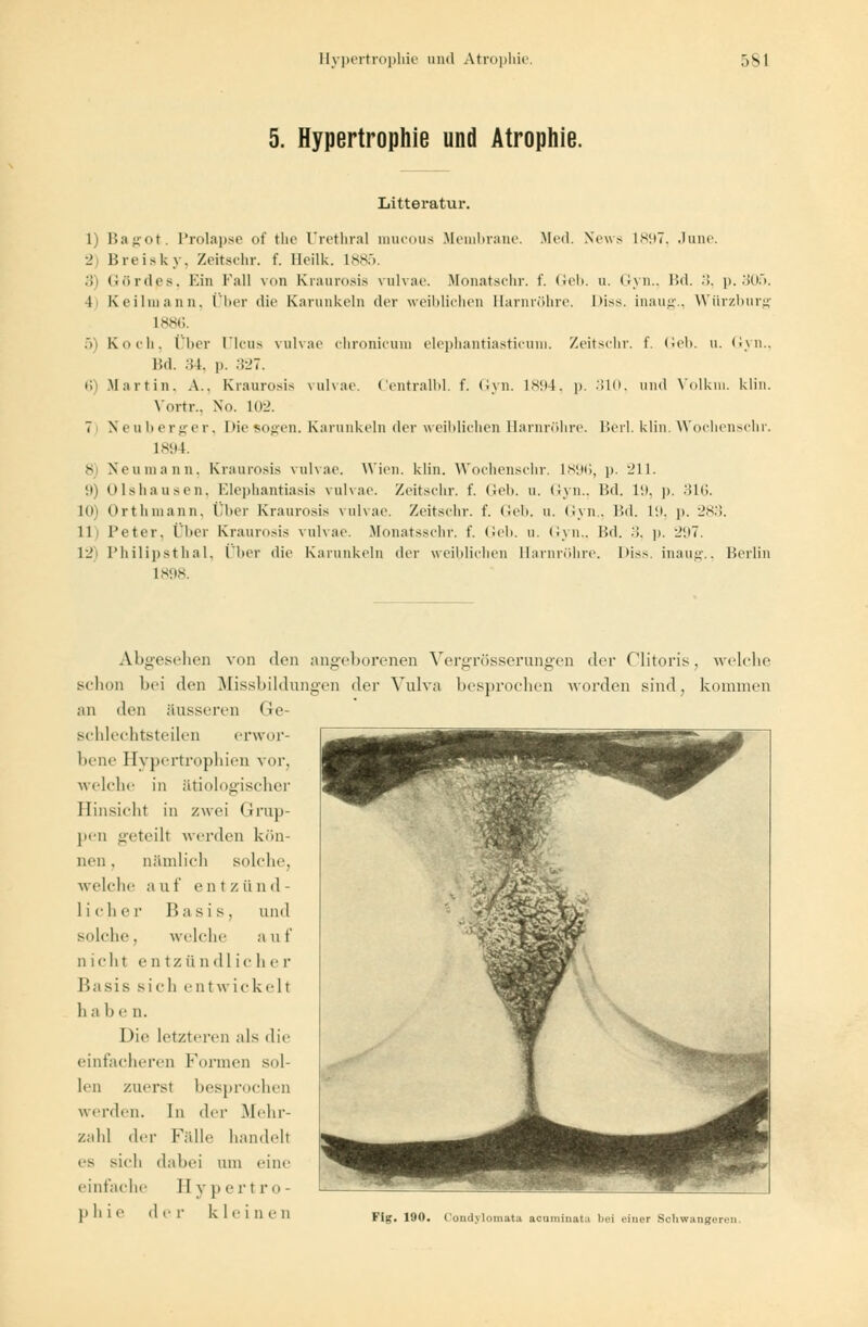 5. Hypertrophie und Atrophie. Litteratur. 1) Bagot. Prolapse of the Urethral mucoua Membrane. Med. News 1897, June. 2 Breisky, Zeitachr. f. Heilk. L885. 3) Gördes, Ein Fall von Kraurosis vulvae. Monatschr. f. Geb. a. Gyn., Bd. .'!. p. 305. 4) Keilmann, Über die Karunkeln der weiblichen Harnröhre, l'iss. inaug., Würzburg 1886. 5) Koch, Über Ulcus vulvae chronicum elephantiasticum. Zeitschr. f. Geb. u. Gyn., Bd. 34, p. 327. 6) Martin. A.. Kraurosis vulvae. Centralbl. f. Gyn. 1894, p. 310, und Vblkm. klin. Vortr., No. L02. 7 Neuberger, Die sogen. Karunkeln der weiblichen Harnröhre. Berl. klin. Wochenschr. 1894. - Neumann, Kraurosis vulvae. Wien. klin. Wochenschr. 1896, p. 211. 9) Olshausen, Elephantiasis vulvae. Zeitschr. f. Geb. u. Gyn., Bd. 19, p. ■ il(>. 10) Ort liniann. Über Kraurosis vulvae. Zeitschr. f. Geb. u. Gyn., Bd. 19, p. 283. 11t Peter, Über Kraurosis vulvae. Monatsschr. f. Geb. u. Gyn,, Bd. .'!. p. _.i7. 12) Philipsthal, Über die Karunkeln der weiblichen Harnröhre. I>is>. inaug., Berlin IN! IS. Abgesehen von den angeborenen Vergrösserungen der Clitoris, welche schon bei den Missbildungen der Vulva besprochen worden sind, kommen an den äusseren Ge- schlechtsteilen erwor- bene Hypertrophien vor, welche in ätiologischer Hinsicht in zwei Grup- pen geteilt werden kön- nen . nämlich solche, welche a u f cntz ü n d - liehe]' Basis, und solche, welche a U t n icht e n tz ii n dl ic h e r IIasis sich entwickelt h a be n. Die letzteren als die einfacheren Formen sol- len zuerst besprochen werden. In der Mehr- zahl der Fälle handelt es sich dabei um eine einfache II yp ertro-