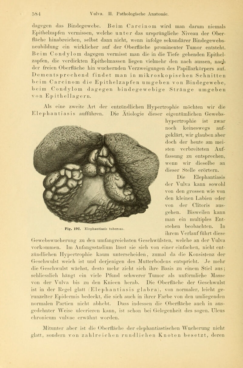 dagegen das Bindegewebe. Beim Carcinom wird man darum niemals Epithelzapfen vermissen, welche unter das ursprüngliche Niveau der Ober- fläche hinabreichen, seihst dann nicht, wenn infolge sekundärer Bindegewebs- neubildung ein wirklicher auf der Oberfläche prominenter Tumor entsteht. Beim Condylom dagegen vermisst man die in die Tiefe gehenden Epithel- zapfen, die verdickten Epithelmassen liegen vielmehr den nach aussen, naeji der freien Oberfläche hin wuchernden Verzweigungen des Papillarkörpers auf. Dementsprechend findet man in mikroskopischen Schnitten heim Carcinom die Epithelzapfen umgeben von Bindegewebe, heim Condylom dagegen bindegewebige Stränge umgeben von E p ithellagern. Als eine zweite Art der entzündlichen Hypertrophie möchten wir die Elephantiasis aufführen. Die Ätiologie dieser eigentümlichen Gewebs- hypertrophie ist zwar noch keineswegs auf- geklärt, wir glauben aber doch der heute am mei- sten verbreiteten Auf- fassung zu entsprechen, wenn wir dieselbe an dieser Stelle erörtern. Die Elephantiasis der Vulva kann sowohl von den grossen wie von den kleinen Labien oder von der Clitoris aus- gehen. Bisweilen kann man ein multiples Ent- stehen beobachten. In ihrem Verlauf führt diese Gewebswucherung zu den umfangreichsten Geschwülsten, welche an der Vulva vorkommen. Im Anfangsstadium lässt sie sich von einer einfachen, nicht ent- zündlichen Hypertrophie kaum unterscheiden, zumal da die Konsistenz der Geschwulst weich ist und derjenigen des Mutterbodens entspricht. Je mehr die Geschwulst wächst, desto mehr zieht sich ihre Basis zu einem Stiel aus: schliesslich hängt ein viele Pfund schwerer Tumor als unförmliche Masse von der Vulva his zu den Knieen herab. Die Oberfläche der Geschwulst ist in der Regel glatt (El ephantiasis srlabra), von normaler, leicht jje- runzelter Epidermis bedeckt, die sich auch in ihrer Farbe von den umliegenden normalen Partien nicht abhebt. Dass indessen die Oberfläche auch in aus- gedehnter Weise ulcerieren kann, ist schon bei Gelegenheit des sogen. Ulcus chronicum vulvae erwähnt worden. Mitunter aber ist die < Iberfläche der elephantiastischen Wucherung nicht glatt, sondern von zahlreichen rundlichen Knoten besetzt, deren Fig. 192. Elephantiasis tuberosa.