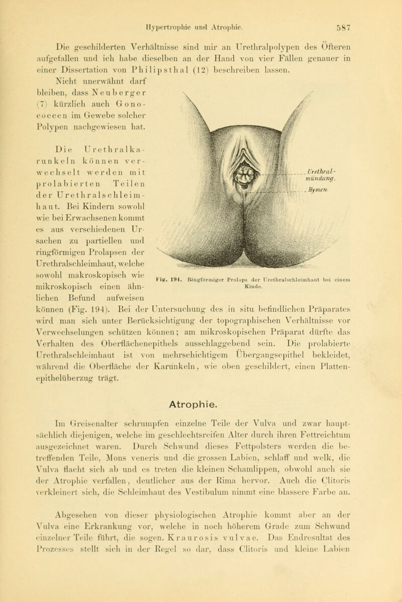 Die geschilderten Verhältnisse sind mir an Urethralpolypen des Öfteren aufgefallen und ich halte dieselben an der Hand von vier Fällen genauer in einer Dissertation von Philipsthal (12) beschreiben lassen. Nicht unerwähnt darf bleiben, dass N e u l> e rge r 7 kürzlich auch GrOno- COCCen im < -ewebe solcher Polypen nachgewiesen hat. Die Urethralka- r u D k e I D k <> n n e n v e r - w e chsell w e rd e n m i t prolabi e vi e o Te ilen . l.'rethral- mündung. Hymen- Hg. 194. der UrethralSchleim- haut. Bei Kindern sowohl wie bei Erwachsenen kommt es aus verschiedenen Ur- sachen zu partiellen und ringförmigen Prolapsen der Urethralschleimhaut, welche sowohl makroskopisch wie mikroskopisch einen ähn- lichen Heflind aufweisen können (Fig. 194). Hei der Untersuchung des in situ befindlichen Präparates wird man sich unter Berücksichtigung der topographischen Verhältnisse vor Verwechselungen schützen können; am mikroskopischen Präparat dürfte das Verhalten des Oberflächenepithels ausschlaggebend sein. Die prolabierte Urethralschleimhaut ist von mehrschichtigem Ubergängsepithel bekleidet, während die Oberfläche der Karunkeln. wie oben geschildert, einen Platten- epithelüberzug trägt. Ringförmiger Prolaps der Urethralschleimhaut bei einem Kinde. Atrophie. Im Greisenalter schrumpfen einzelne Teile der Vulva und zwar haupt- sächlich diejenigen, welche im geschlechtsreifen Alter durch ihren Fettreichtum ausgezeichnet waren. Durch Schwund dieses Fettpolsters werden die be- treffenden Teile, Mens veiieris und die grossen Labien, schlaff und welk, die Vulva tlacht sich ab und es treten die kleinen Schamlippen, obwohl auch sie der Atrophie verfallen, deutlicher aus der Pirna hervor. Auch die Clitoris verkleinert sich, die Schleimhaut des Vestibulum nimmt eine blassere Farbe an. Abgesehen von dieser physiologischen Atrophie kommt aber an der Vulva eine Erkrankung vor, welche in noch höherem Grade zum Schwund einzelner Teile führt, die sogen. Kraurosis vulvae. Das Endresultat des und kleine Labien Prozesses stellt der Regel so dar, dass Cht»