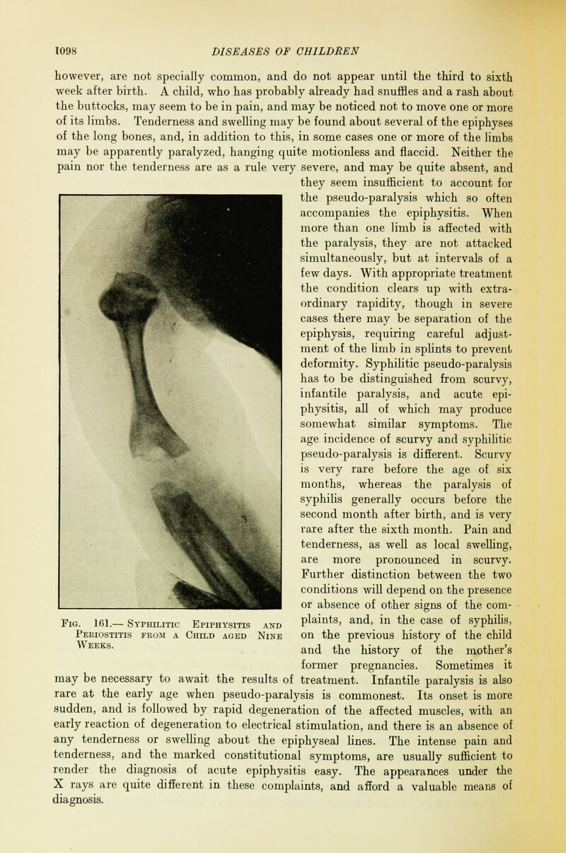 however, are not specially common, and do not appear until the third to sixth week after birth. A child, who has probably already had snuffles and a rash about the buttocks, may seem to be in pain, and may be noticed not to move one or more of its limbs. Tenderness and swelling may be found about several of the epiphyses of the long bones, and, in addition to this, in some cases one or more of the limbs may be apparently paralyzed, hanging quite motionless and flaccid. Neither the pain nor the tenderness are as a rule very severe, and may be quite absent, and they seem insufficient to account for the pseudo-paralysis which so often accompanies the epiphysitis. When more than one limb is affected with the paralysis, they are not attacked simultaneously, but at intervals of a few days. With appropriate treatment the condition clears up with extra- ordinary rapidity, though in severe cases there may be separation of the epiphysis, requiring careful adjust- ment of the limb in splints to prevent deformity. Syphilitic pseudo-paralysis has to be distinguished from scurvy, infantile paralysis, and acute epi- physitis, all of which may produce somewhat similar symptoms. The age incidence of scurvy and syphilitic pseudo-paralysis is different. Scurvy is very rare before the age of six months, whereas the paralysis of syphilis generally occurs before the second month after birth, and is very rare after the sixth month. Pain and tenderness, as well as local swelling, are more pronounced in scurvy. Further distinction between the two conditions will depend on the presence or absence of other signs of the com- plaints, and, in the case of syphilis, on the previous history of the child and the history of the mother's former pregnancies. Sometimes it may be necessary to await the results of treatment. Infantile paralysis is also rare at the early age when pseudo-paralysis is commonest. Its onset is more sudden, and is followed by rapid degeneration of the affected muscles, with an early reaction of degeneration to electrical stimulation, and there is an absence of any tenderness or swelling about the epiphyseal lines. The intense pain and tenderness, and the marked constitutional symptoms, are usually sufficient to render the diagnosis of acute epiphysitis easy. The appearances under the X rays are quite different in these complaints, and afford a valuable means of diagnosis. Fig. 161.— Syphilitic Epiphysitis Periostitis from a Child aged Weeks. and Nine