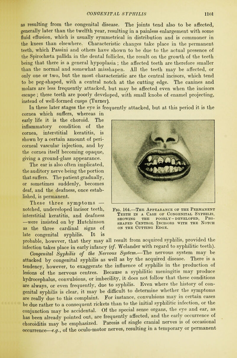 as resulting from the congenital disease. The joints tend also to be affected, generally later than the twelfth year, resulting in a painless enlargement with some fluid effusion, which is usually symmetrical in distribution and is commoner in the knees than elsewhere. Characteristic changes take place in the permanent teeth, which Passini and others have shown to be due to the actual presence of the Spirochaeta pallida in the dental follicles, the result on the growth of the teeth being that there is a general hypoplasia ; the affected teeth are therefore smaller than the normal and somewhat misshapen. All the teeth may be affected, or only one or two, but the most characteristic are the central incisors, which tend to be peg-shaped, with a central notch at the cutting edge. The canines and molars are less frequently attacked, but may be affected even when the incisors escape ; these teeth are poorly developed, with small knobs of enamel projecting, instead of well-formed cusps (Turner). In these later stages the eye is frequently attacked, but at this period it is the cornea which suffers, whereas in early life it is the choroid. The inflammatory condition of the cornea, interstitial keratitis, is shown by a certain amount of peri- corneal vascular injection, and by the cornea itself becoming opaque, giving a ground-glass appearance. The ear is also often implicated, the auditory nerve being the portion that suffers. The patient gradually, or sometimes suddenly, becomes deaf, and the deafness, once estab- lished, is permanent. These three symptoms — notched, undeveloped incisor teeth, interstitial keratitis, and deafness —were insisted on by Hutchinson as the three cardinal signs of late congenital syphilis. It is probable, however, that they may all result from acquired syphilis, provided the infection takes place in early infancy (cf. Welander with regard to syphilitic teeth). Congenital Syphilis of the Nervous System.—The nervous system may be attacked by congenital syphilis as well as by the acquired disease. There is a tendency, however, to exaggerate the influence of syphilis in the production of lesions of the nervous centres. Because a syphilitic meningitis may produce hydrocephalus, convulsions, or imbecility, it does not follow that these conditions are always, or even frequently, due to syphilis. Even where the history of con- genital syphilis is clear, it may be difficult to determine whether the symptoms are really due to this complaint. For instance, convulsions may in certain cases be due rather to a consequent rickets than to the initial syphilitic infection, or the conjunction may be accidental. Of the special sense organs, the eye and ear, as has been already pointed out, are frequently affected, and the early occurrence of choroiditis may be emphasized. Paresis of single cranial nerves is of occasional occurrence—e.g., of the oculo-motor nerves, resulting in a temporary or permanent Fig. 164.—The Appearance of the Permanent Teeth in a Case of Congenital Syphilis, SHOWING THE POOKLY-DEVELOPED, PeG- shaped Cbntrol Incisors with the Notch on the Cutting Edge.