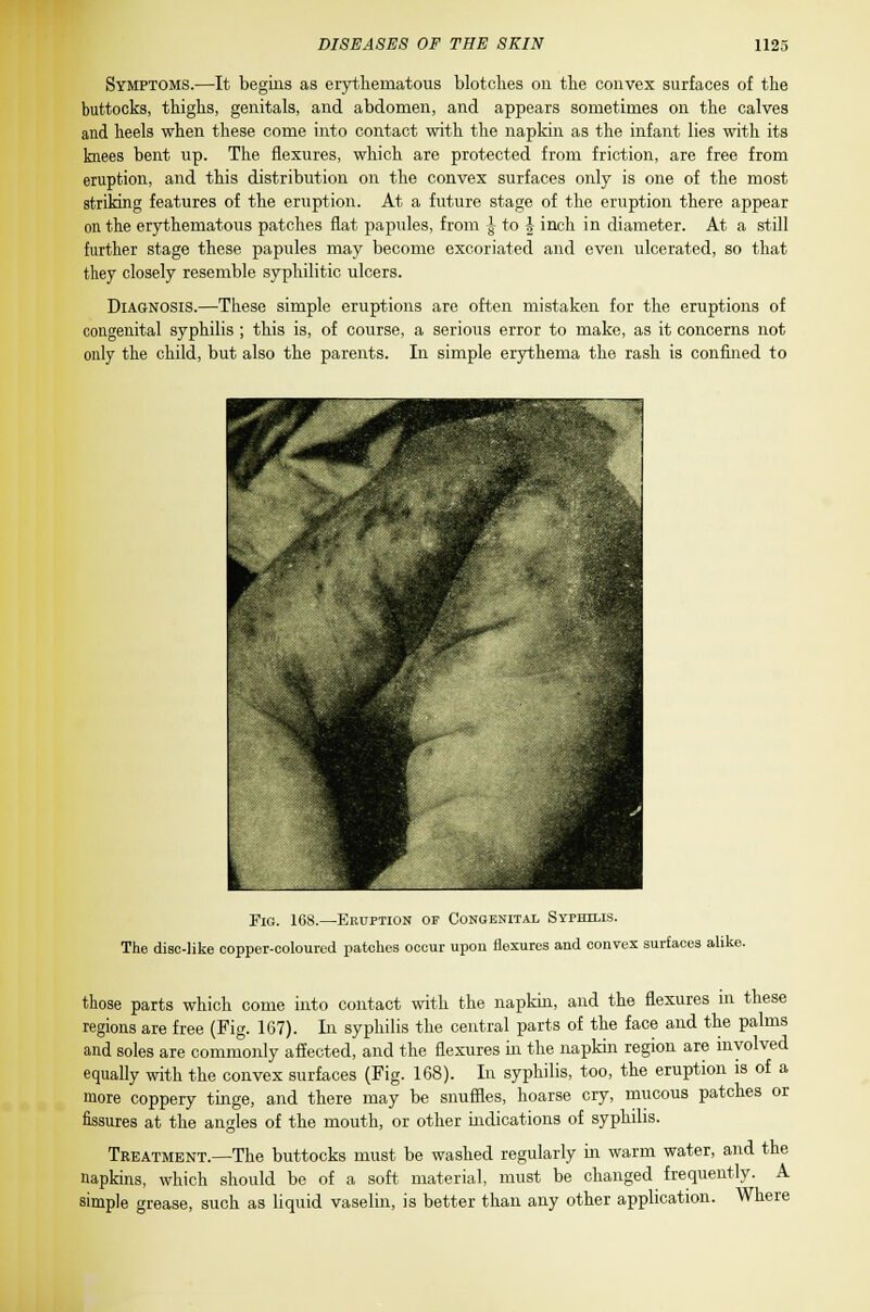 Symptoms.—It begins as erythematous blotches on the convex surfaces of the buttocks, thighs, genitals, and abdomen, and appears sometimes on the calves and heels when these come into contact with the napkin as the infant lies with its knees bent up. The flexures, which are protected from friction, are free from eruption, and this distribution on the convex surfaces only is one of the most striking features of the eruption. At a future stage of the eruption there appear on the erythematous patches flat papules, from £ to \ inch in diameter. At a still further stage these papules may become excoriated and even ulcerated, so that they closely resemble syphilitic ulcers. Diagnosis.—These simple eruptions are often mistaken for the eruptions of congenital syphilis ; this is, of course, a serious error to make, as it concerns not only the child, but also the parents. In simple erythema the rash is confined to Tig. 168.—Eruption of Congenital Syphilis. The disc-like copper-coloured patches occur upon flexures and convex surfaces alike. those parts which come into contact with the napkin, and the flexures in these regions are free (Fig. 167). In syphilis the central parts of the face and the palms and soles are commonly affected, and the flexures in the napkin region are involved equally with the convex surfaces (Fig. 168). In syphilis, too, the eruption is of a more coppery tinge, and there may be snuffles, hoarse cry, mucous patches or fissures at the angles of the mouth, or other indications of syphilis. Treatment.—The buttocks must be washed regularly in warm water, and the napkins, which should be of a soft material, must be changed frequently. A simple grease, such as liquid vaselin, is better than any other application. Where